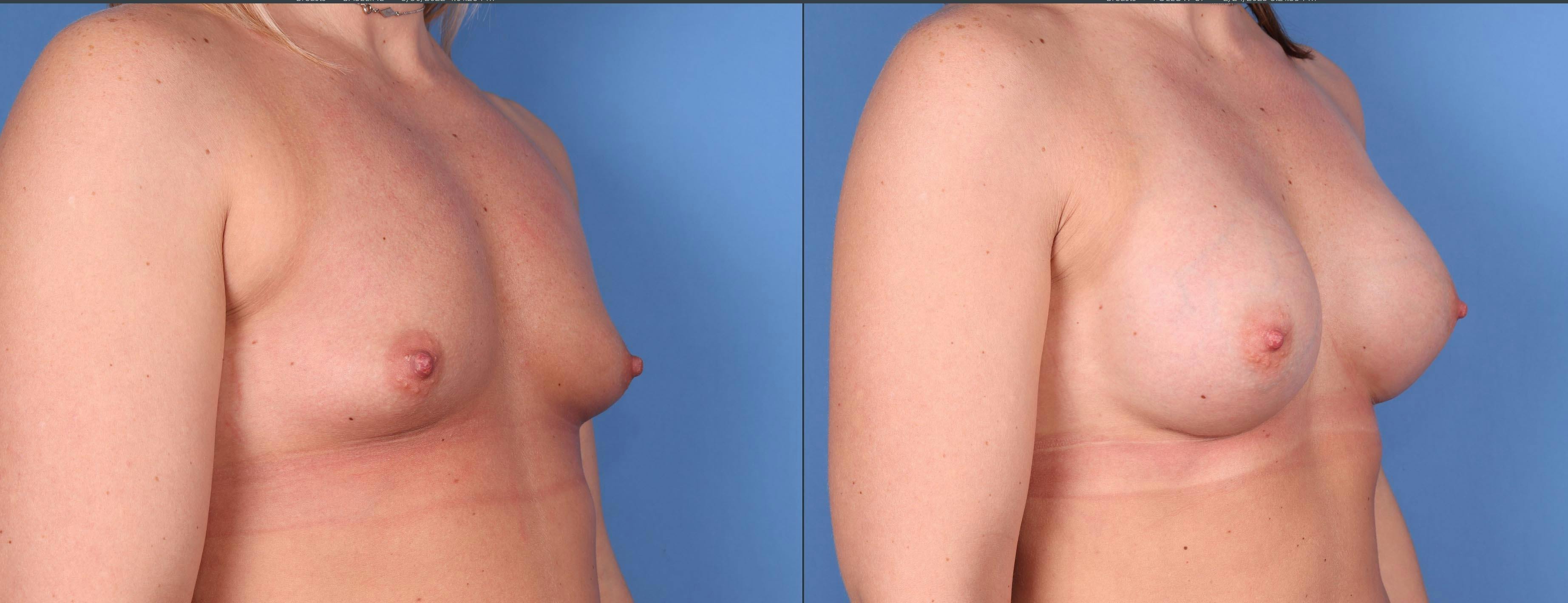 Breast Augmentation Before & After Gallery - Patient 146753386 - Image 2