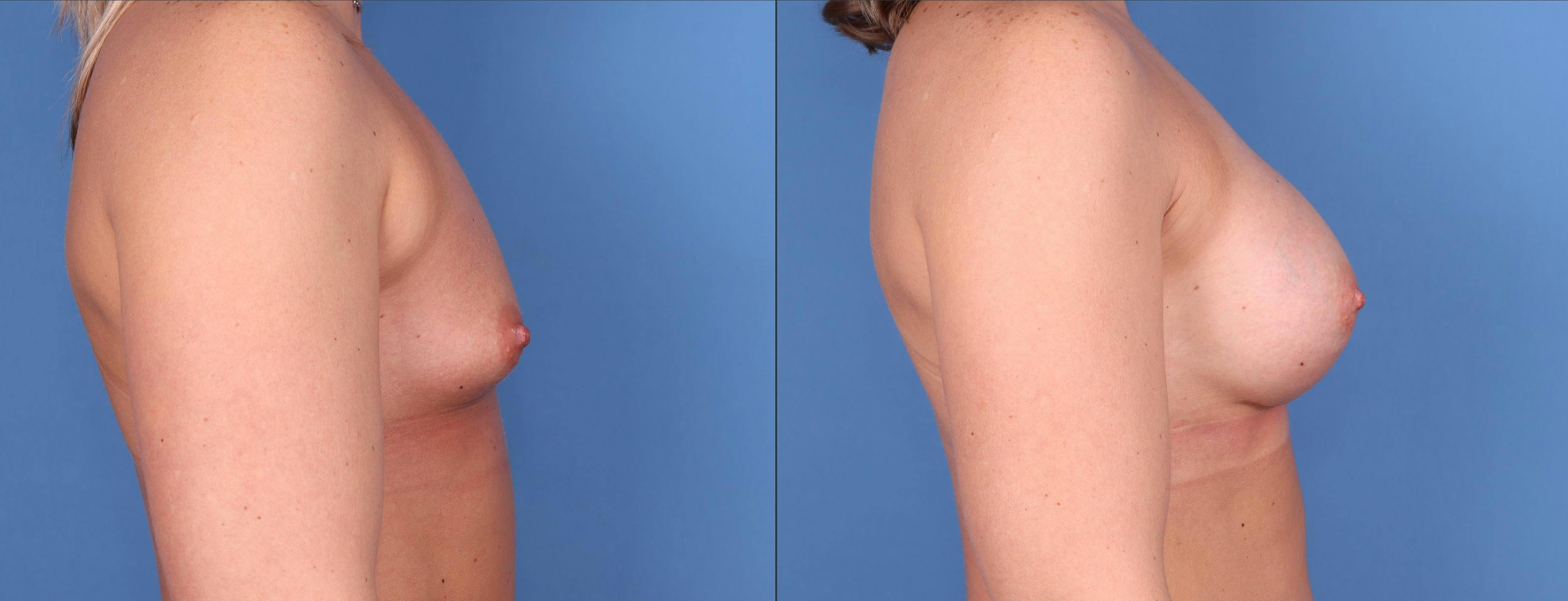 Breast Augmentation Before & After Gallery - Patient 146753386 - Image 3