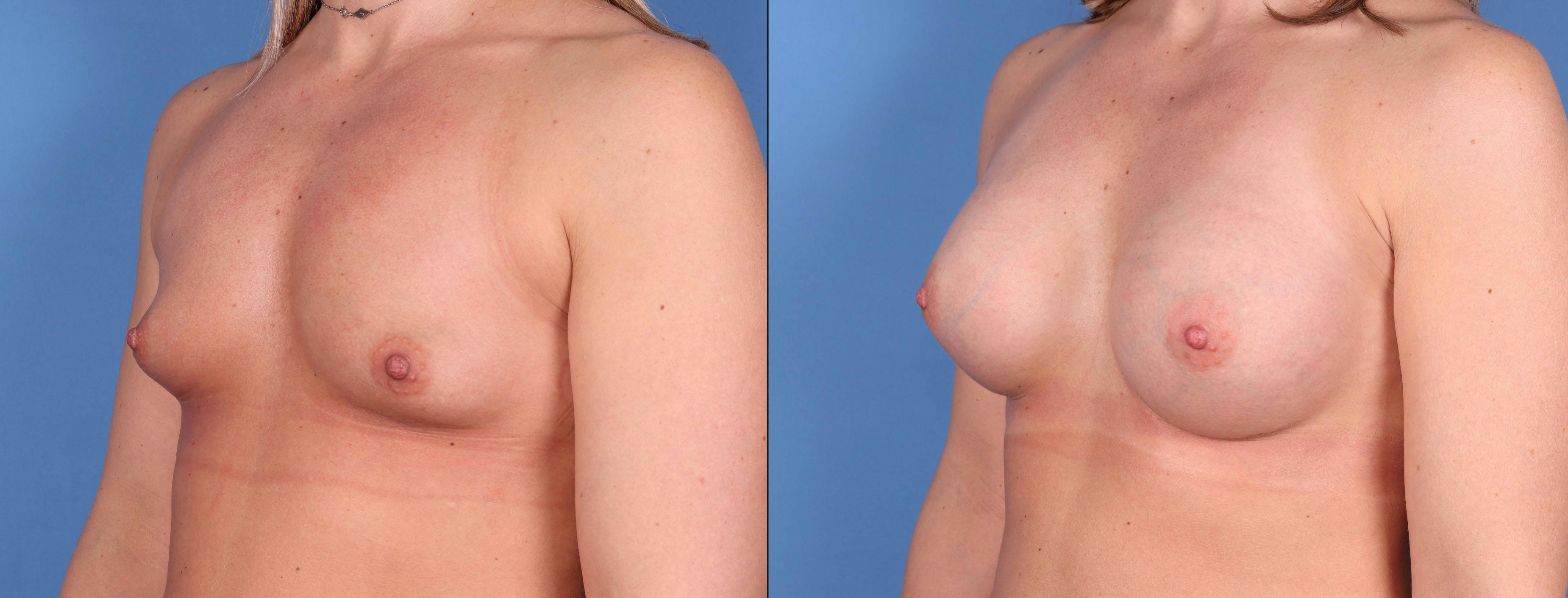 Breast Augmentation Before & After Gallery - Patient 146753386 - Image 4
