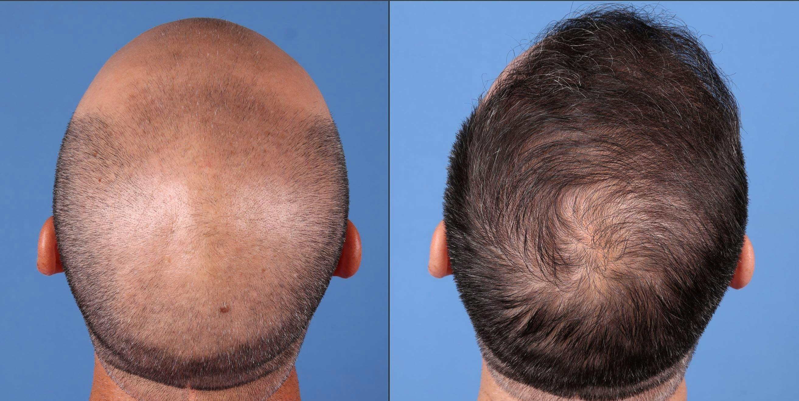 NeoGraft Hair Restoration Before & After Gallery - Patient 146753514 - Image 3