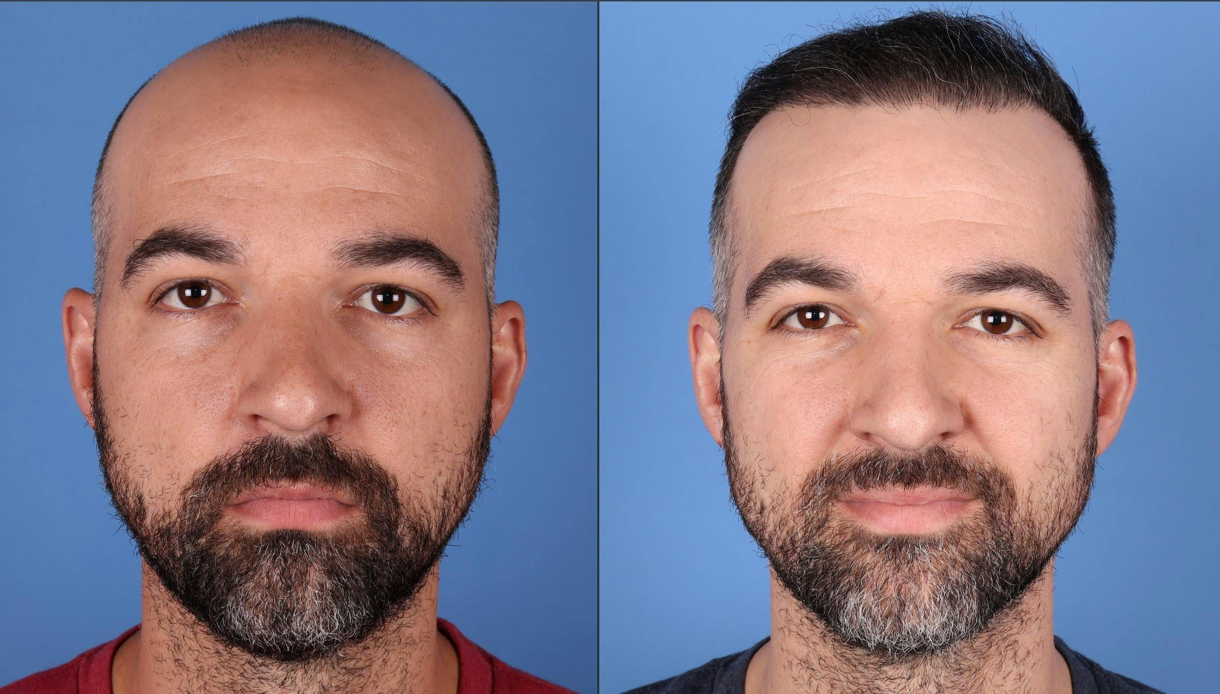 NeoGraft Hair Restoration Before & After Gallery - Patient 146753514 - Image 1
