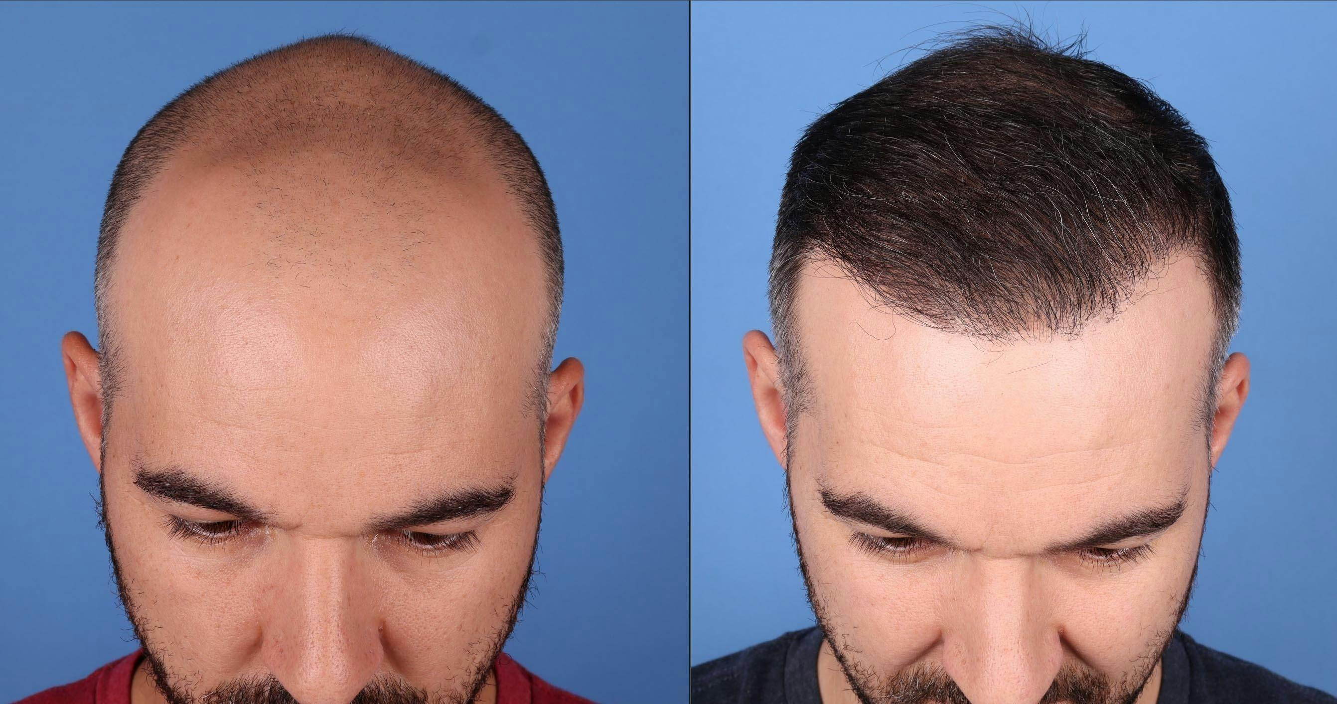NeoGraft Hair Restoration Before & After Gallery - Patient 146753514 - Image 2