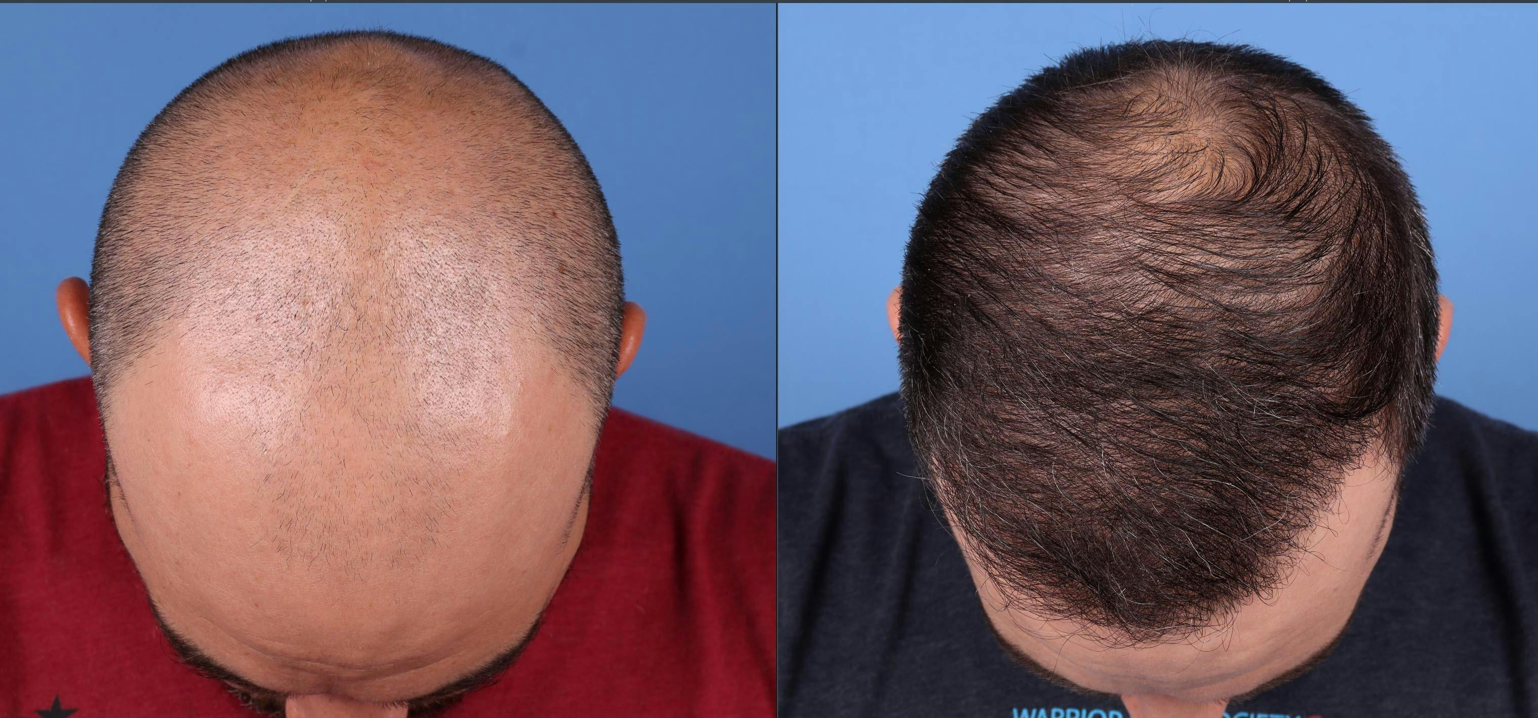 NeoGraft Hair Restoration Before & After Gallery - Patient 146753514 - Image 4