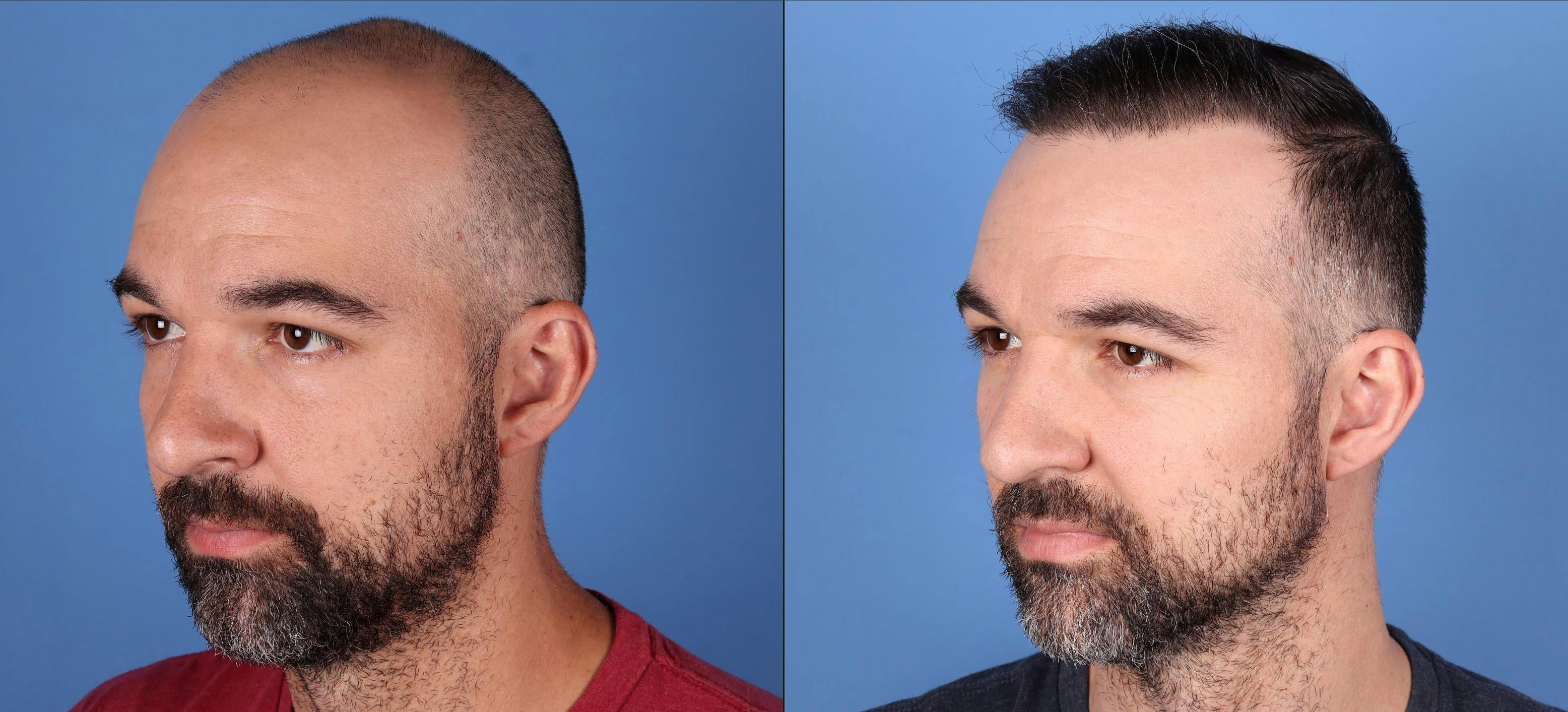 NeoGraft Hair Restoration Before & After Gallery - Patient 146753514 - Image 5