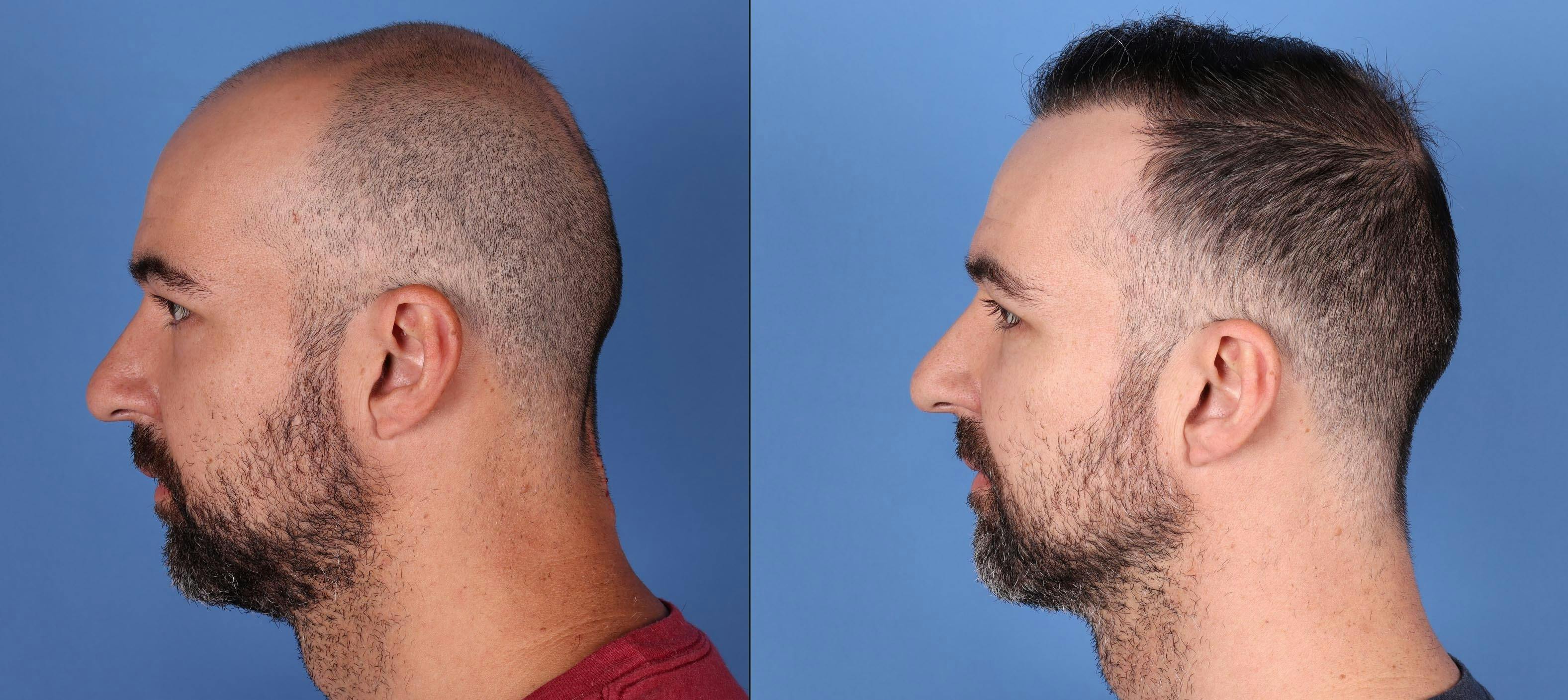 NeoGraft Hair Restoration Before & After Gallery - Patient 146753514 - Image 6
