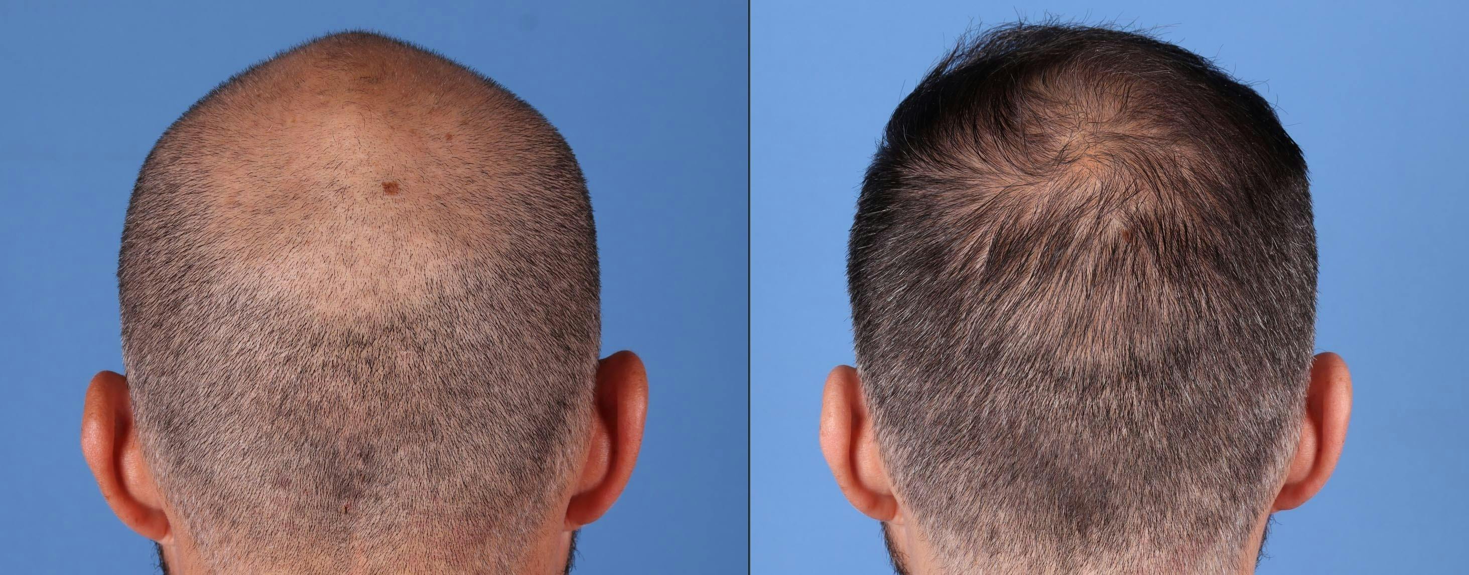 NeoGraft Hair Restoration Before & After Gallery - Patient 146753514 - Image 7
