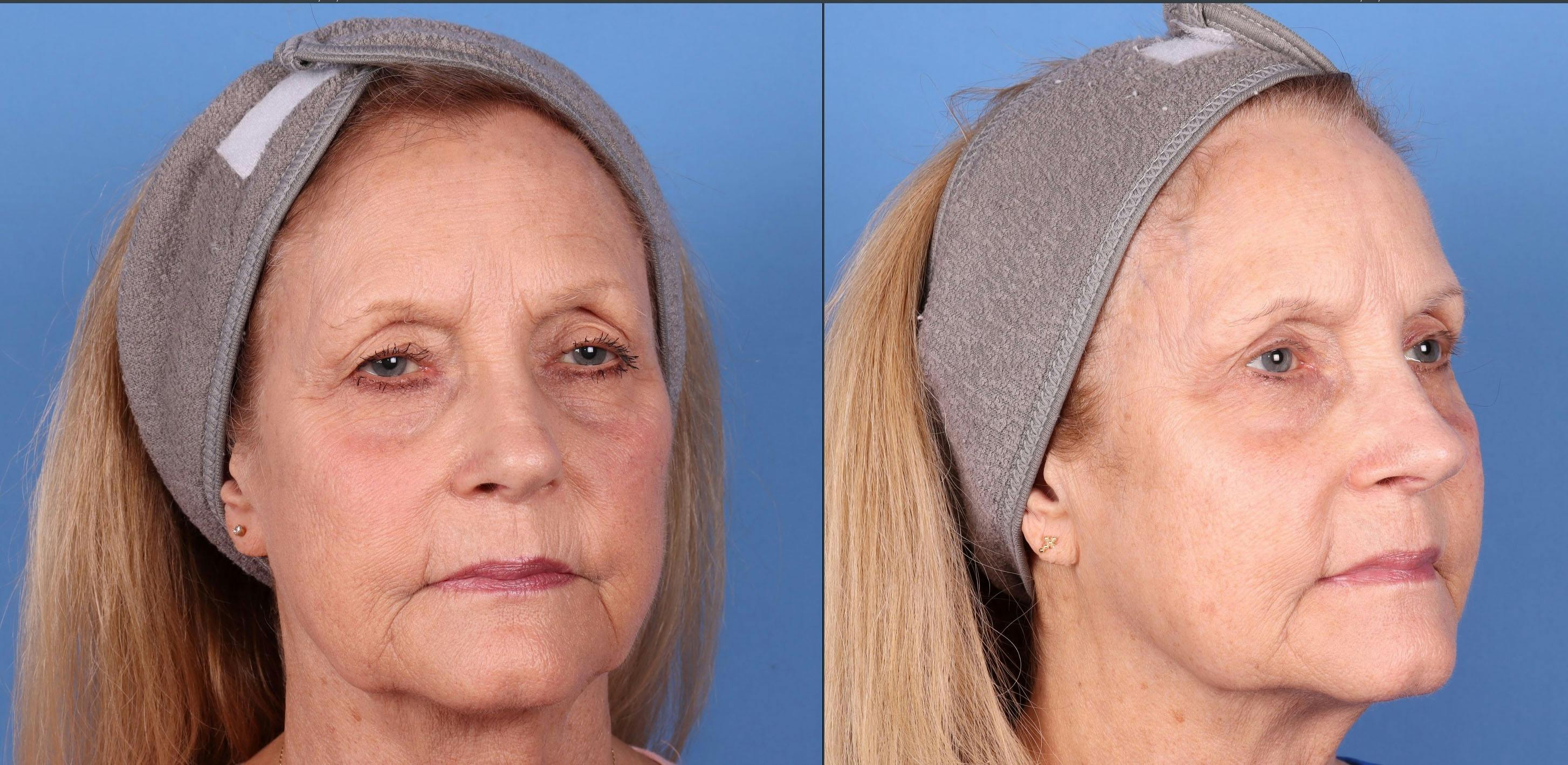 Eyelid Surgery (Blepharoplasty) Before & After Gallery - Patient 146779536 - Image 2