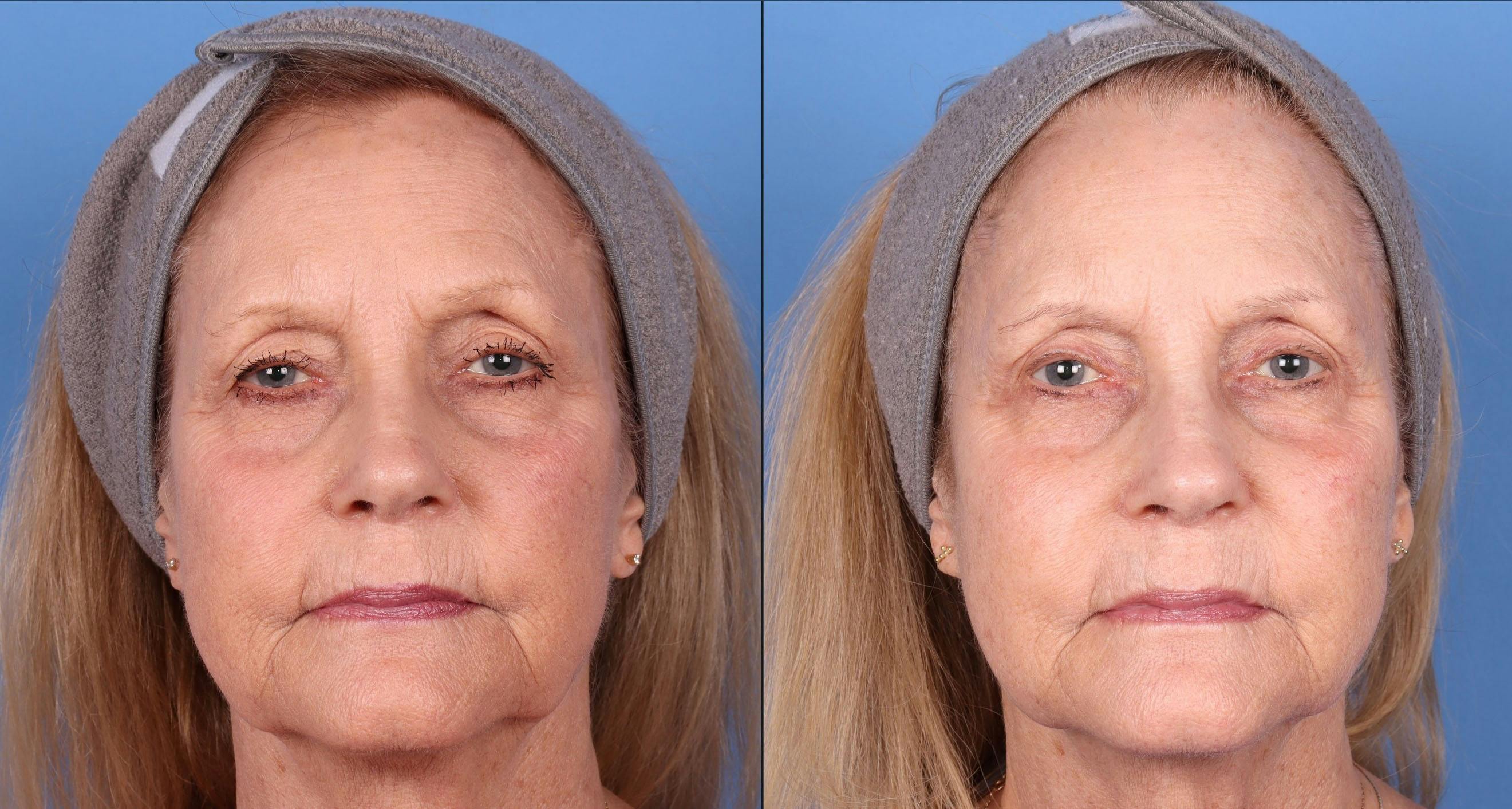 Eyelid Surgery (Upper Blepharoplasty) Before & After Gallery - Patient 146779536 - Image 1