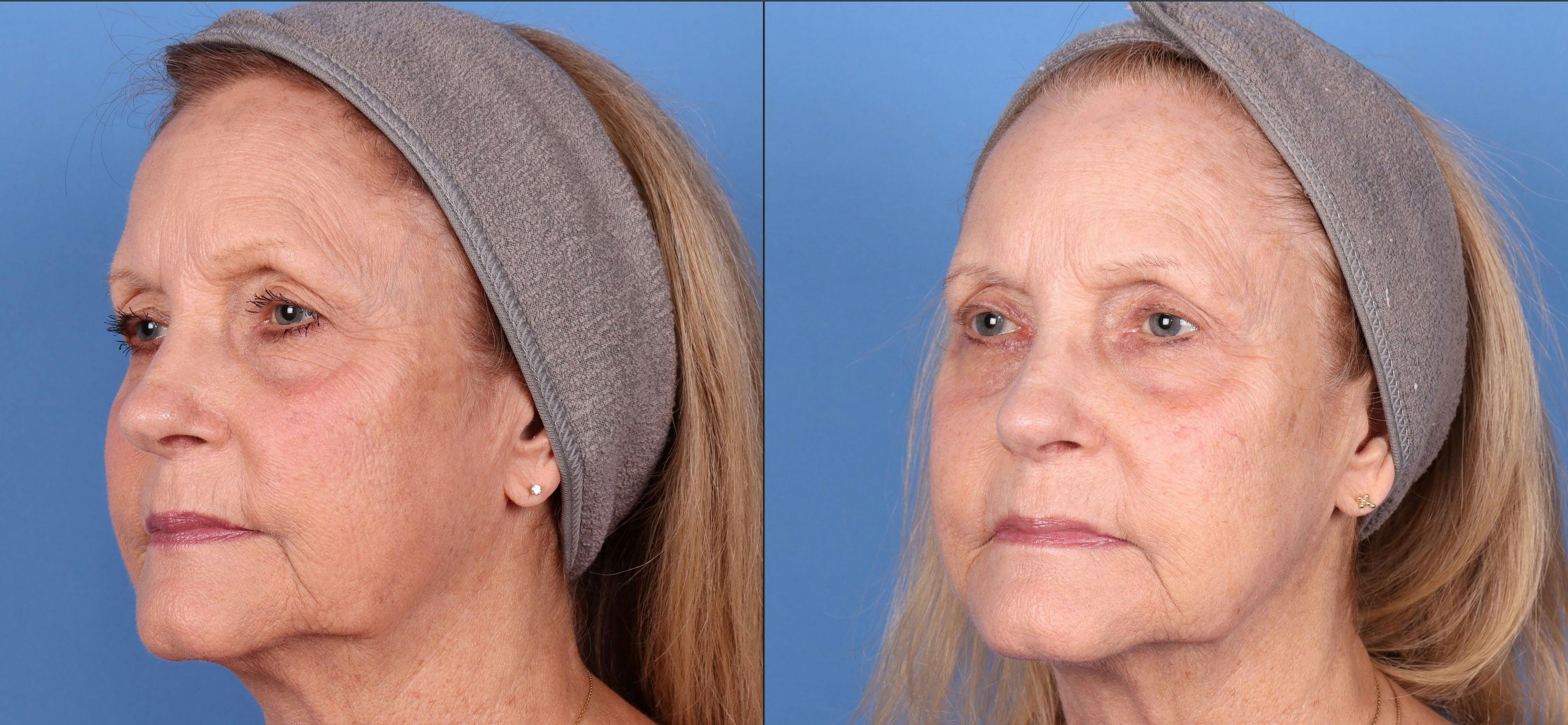 Eyelid Surgery (Blepharoplasty) Before & After Gallery - Patient 146779536 - Image 3