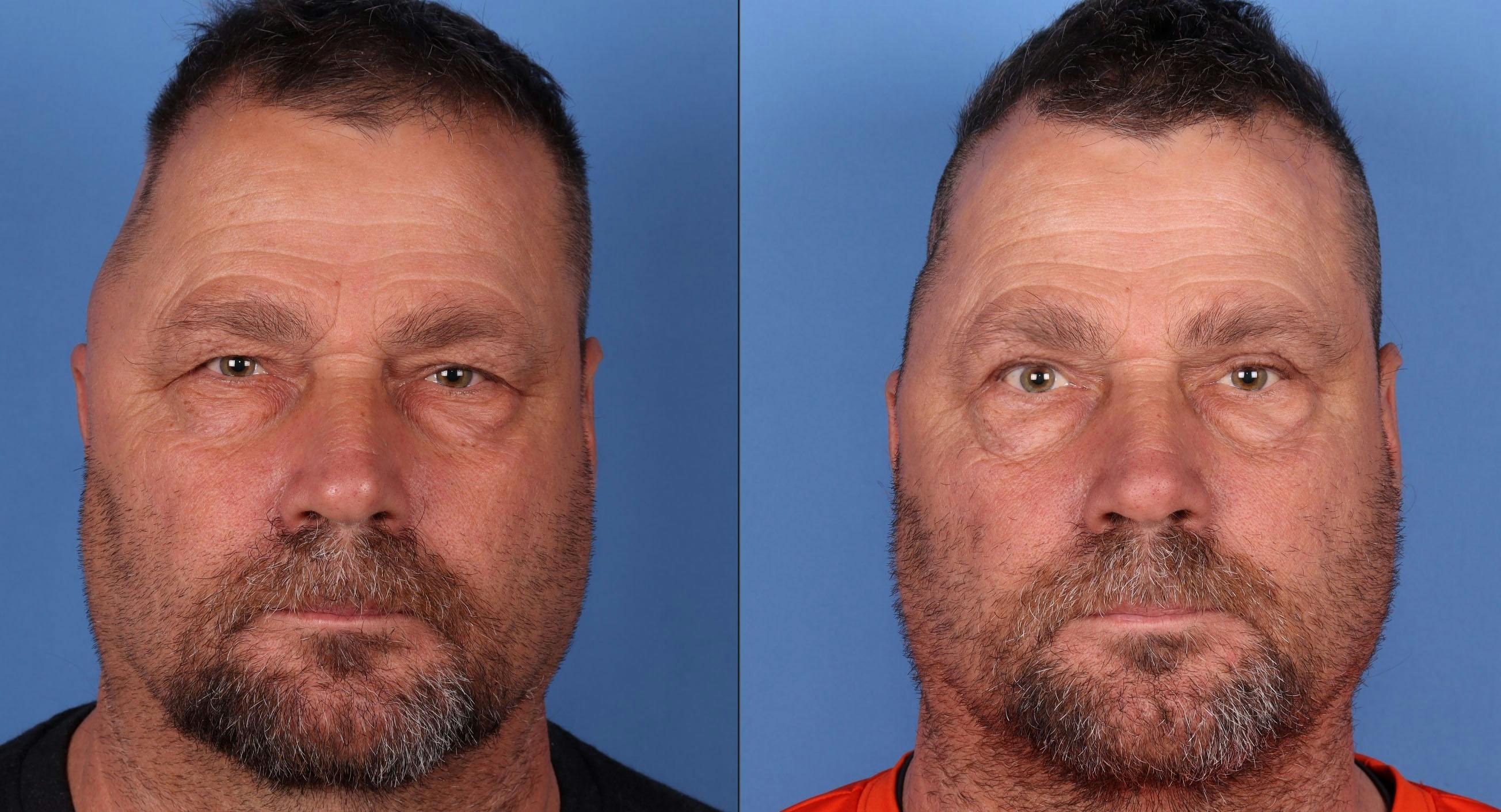 Eyelid Surgery (Upper Blepharoplasty) Before & After Gallery - Patient 146779819 - Image 1