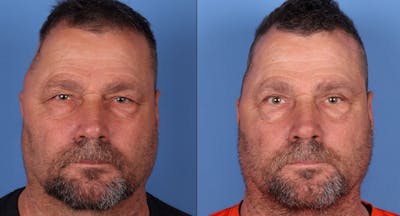 Eyelid Surgery (Upper Blepharoplasty) Before & After Gallery - Patient 146779819 - Image 1