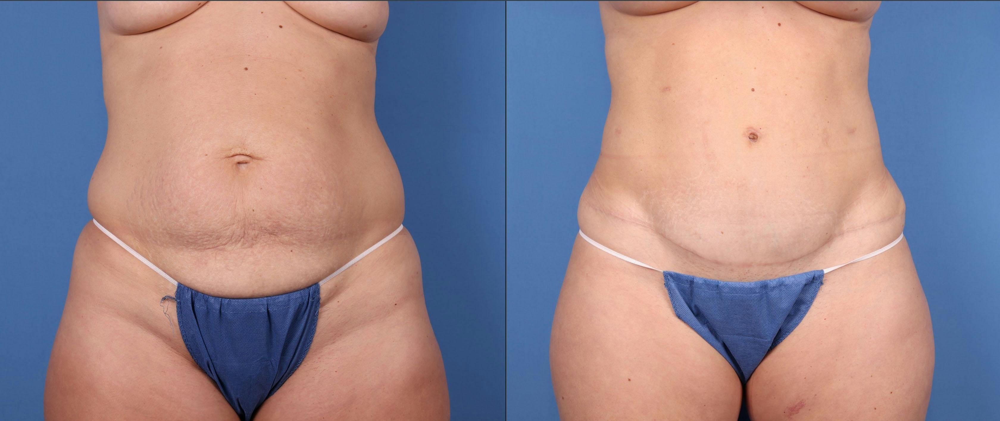 Tummy Tuck Before & After Gallery - Patient 146779825 - Image 1