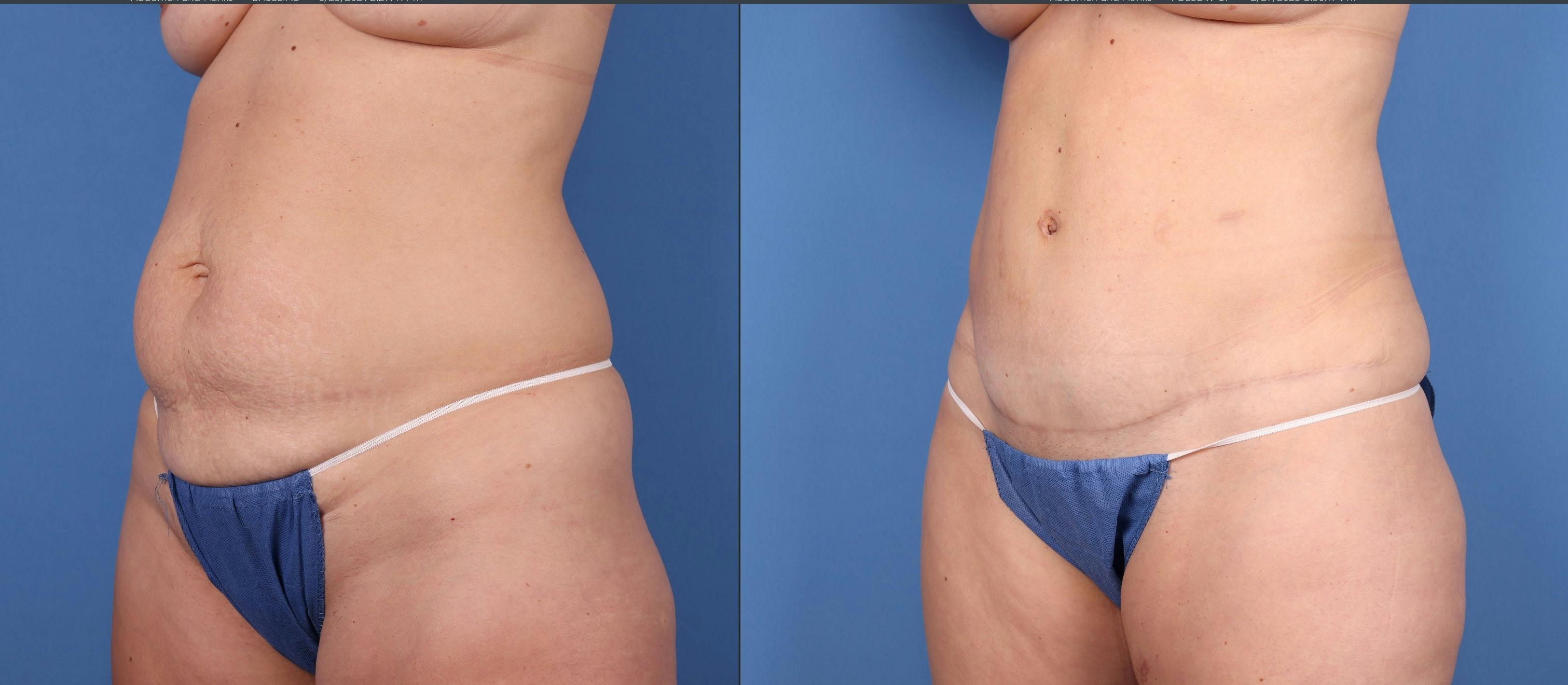 Tummy Tuck Before & After Gallery - Patient 146779825 - Image 2