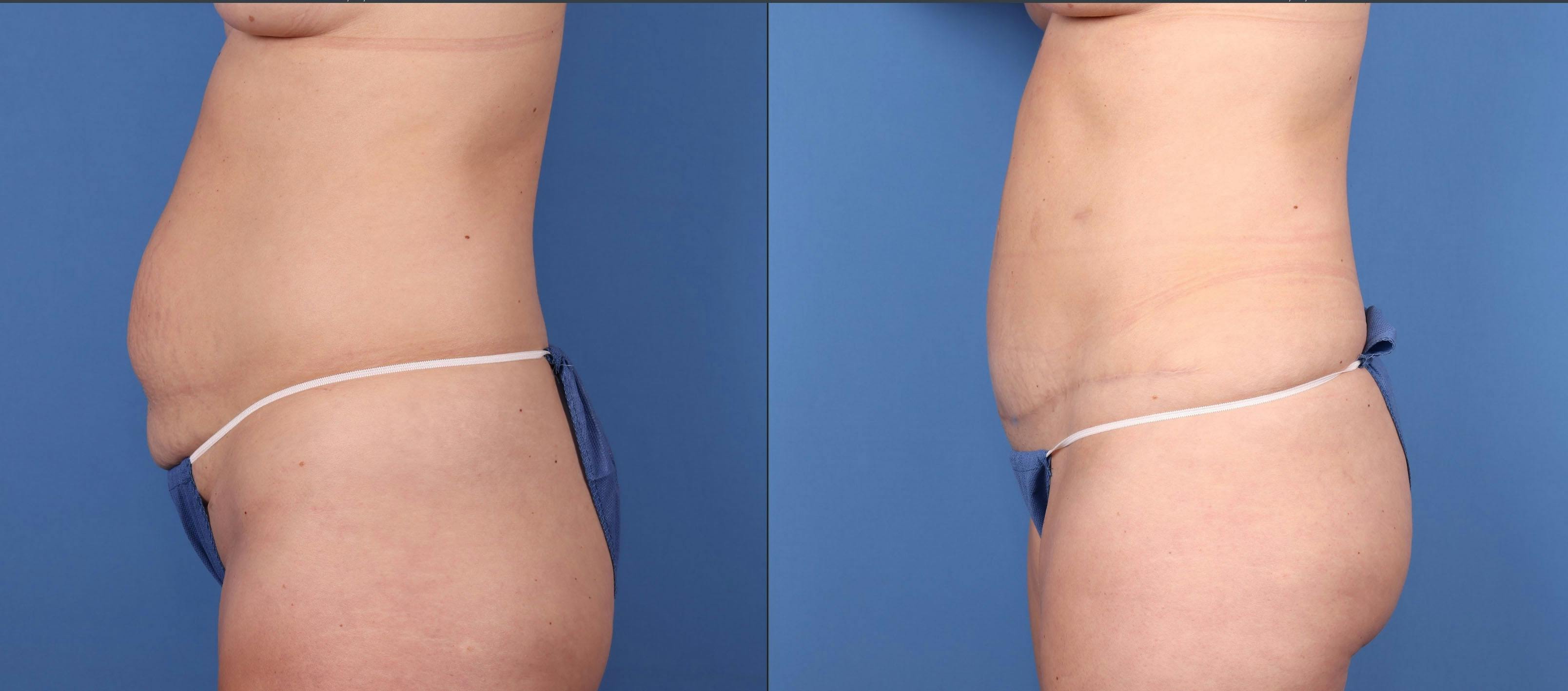 Tummy Tuck Before & After Gallery - Patient 146779825 - Image 3