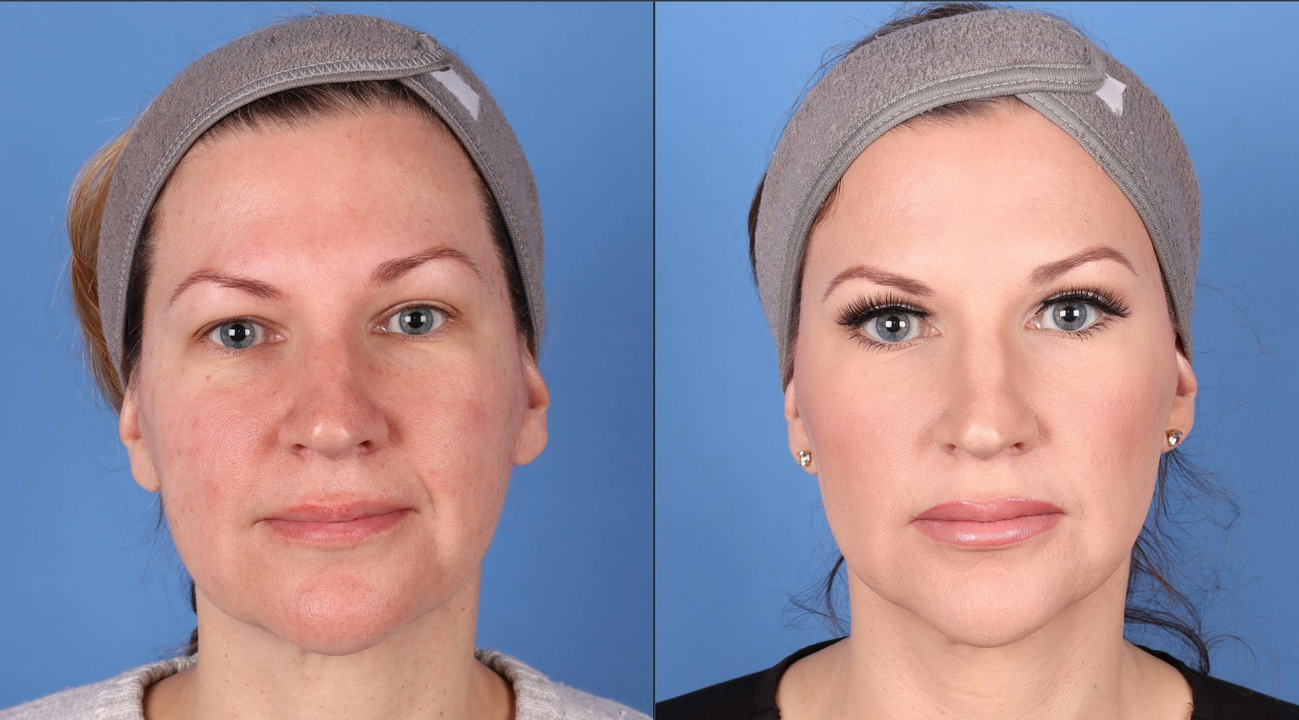 Eyelid Surgery (Upper Blepharoplasty) Before & After Gallery - Patient 146826712 - Image 1