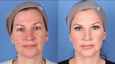 Eyelid Surgery (Upper Blepharoplasty) Before & After Gallery - Patient 146826712 - Image 1