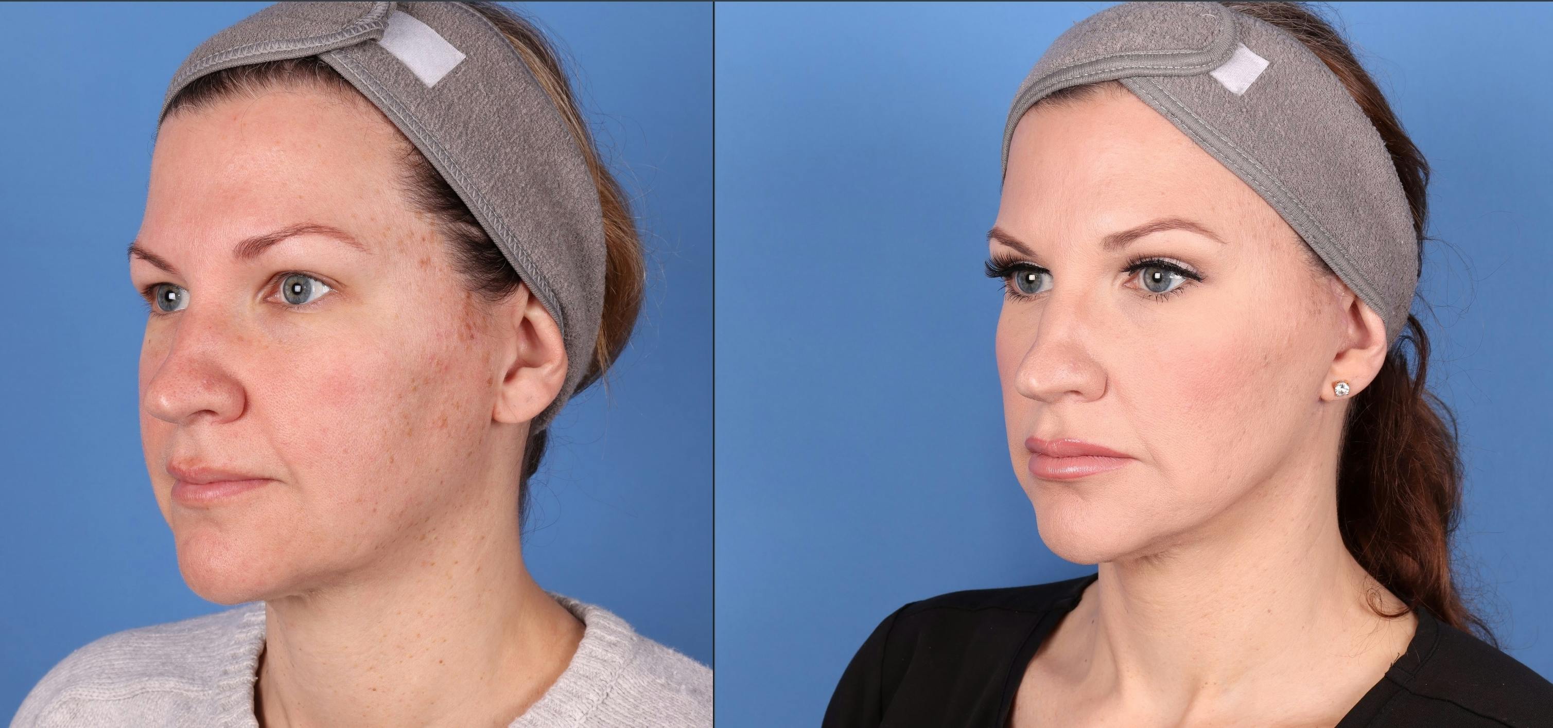 Eyelid Surgery (Upper Blepharoplasty) Before & After Gallery - Patient 146826712 - Image 3
