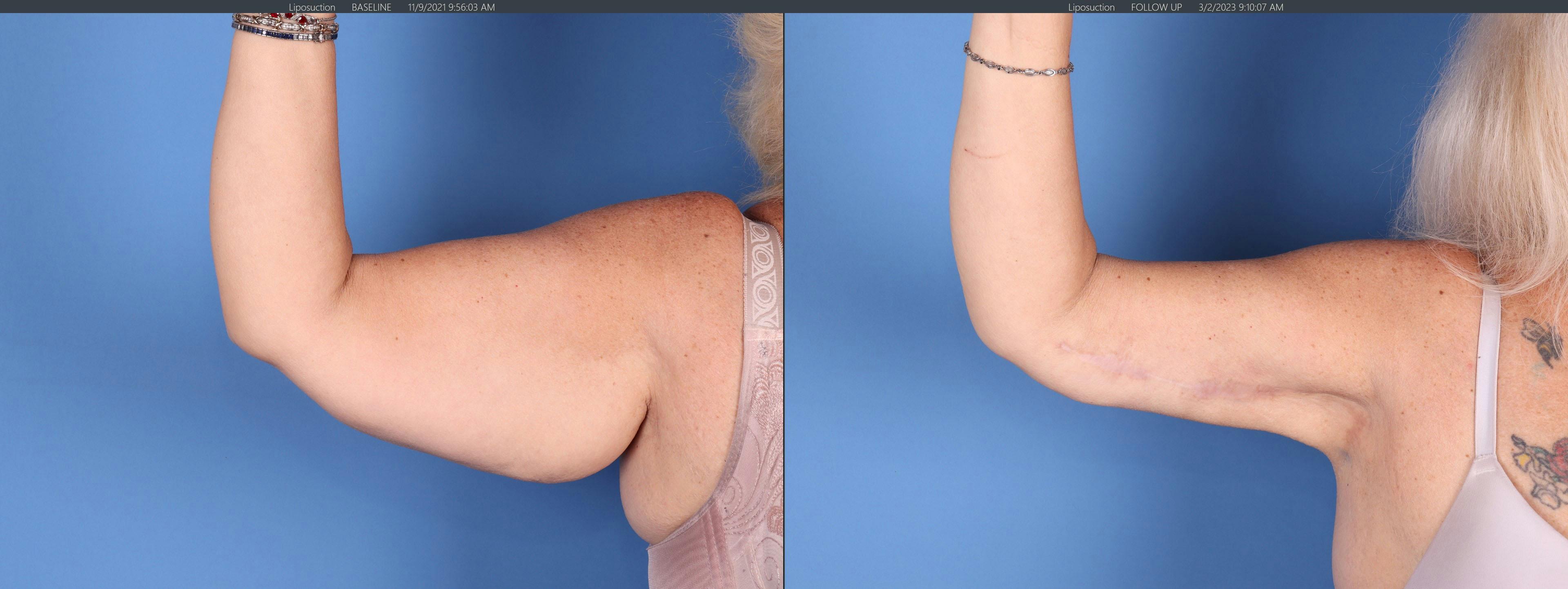 Arm Lift Before & After Gallery - Patient 764541 - Image 1