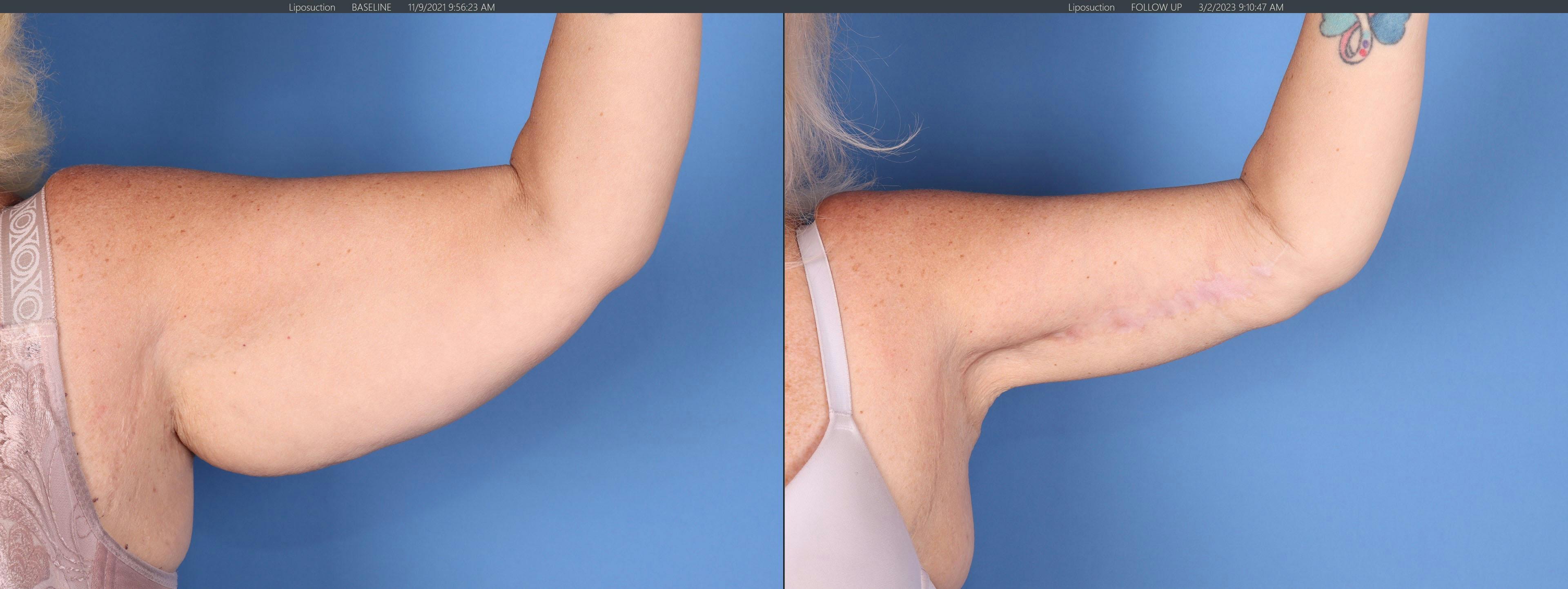 Arm Lift Before & After Gallery - Patient 764541 - Image 2