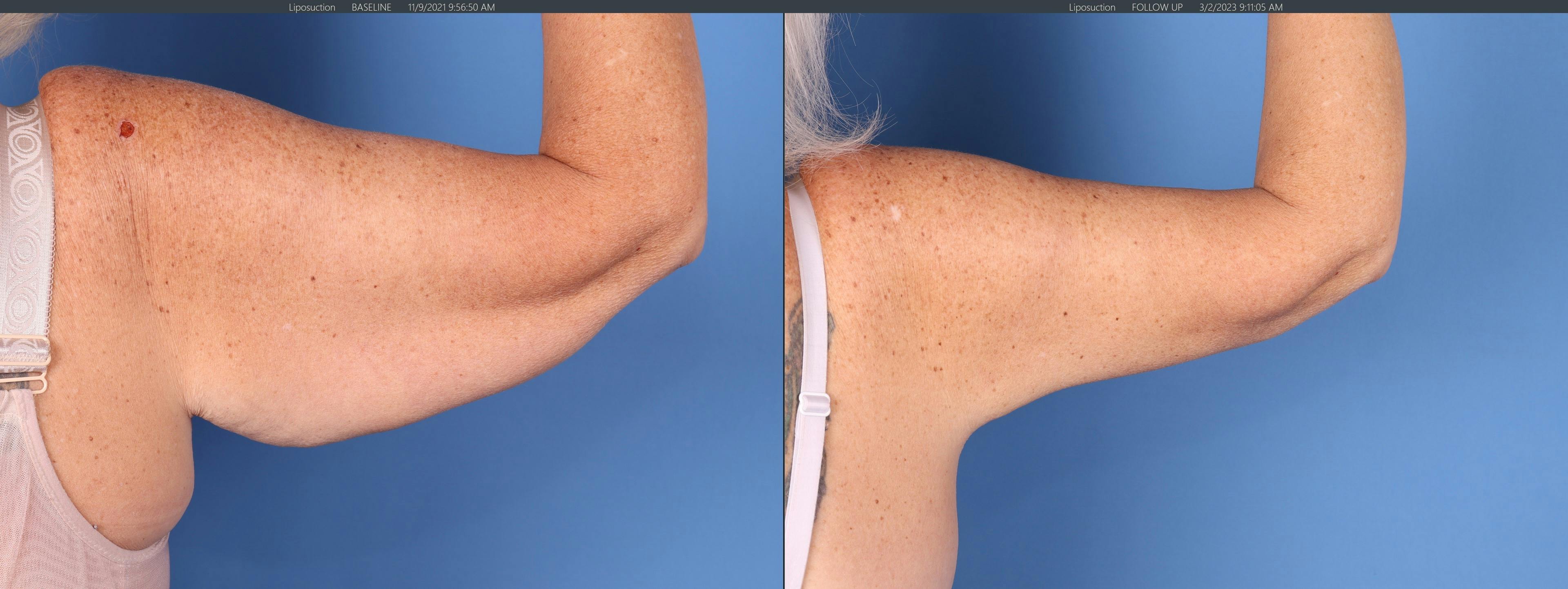 Arm Lift Before & After Gallery - Patient 146924656 - Image 3
