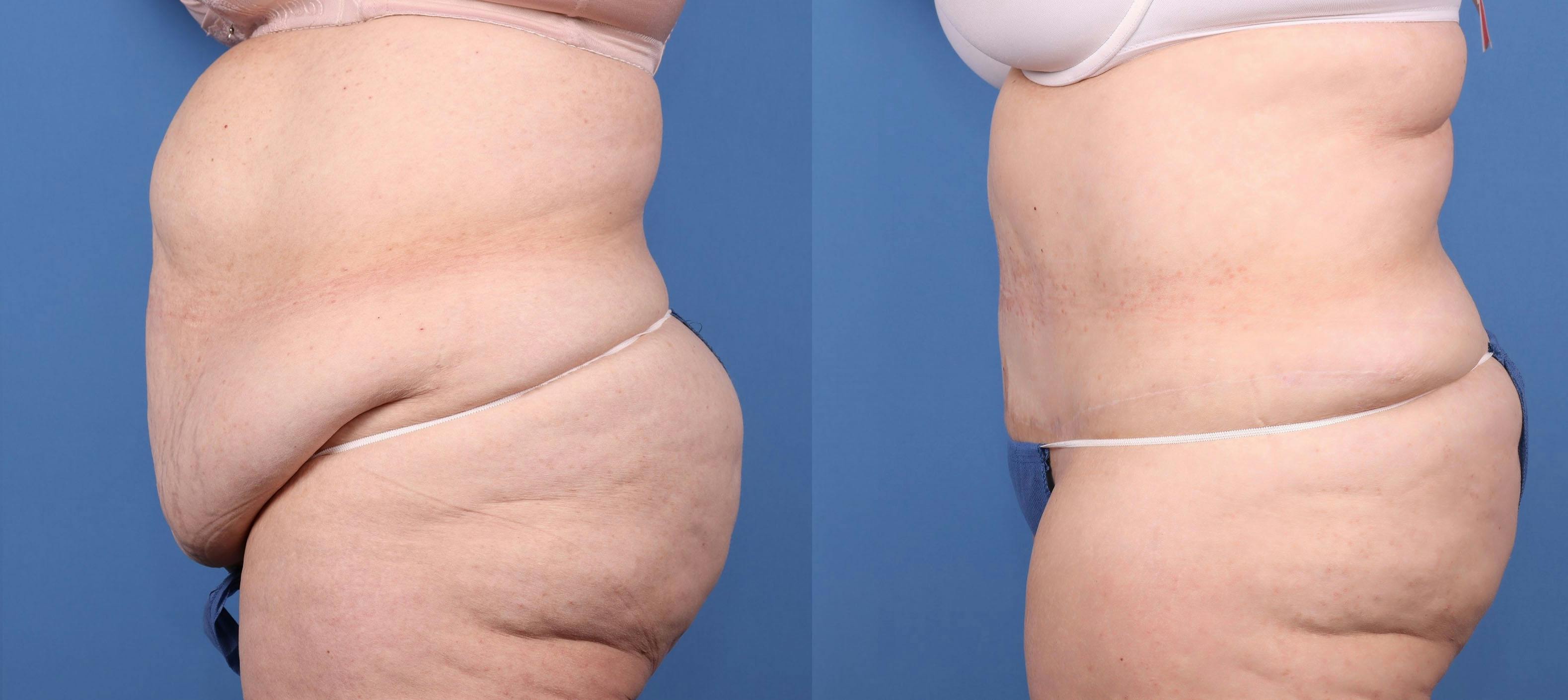 Tummy Tuck Before & After Gallery - Patient 146924658 - Image 3