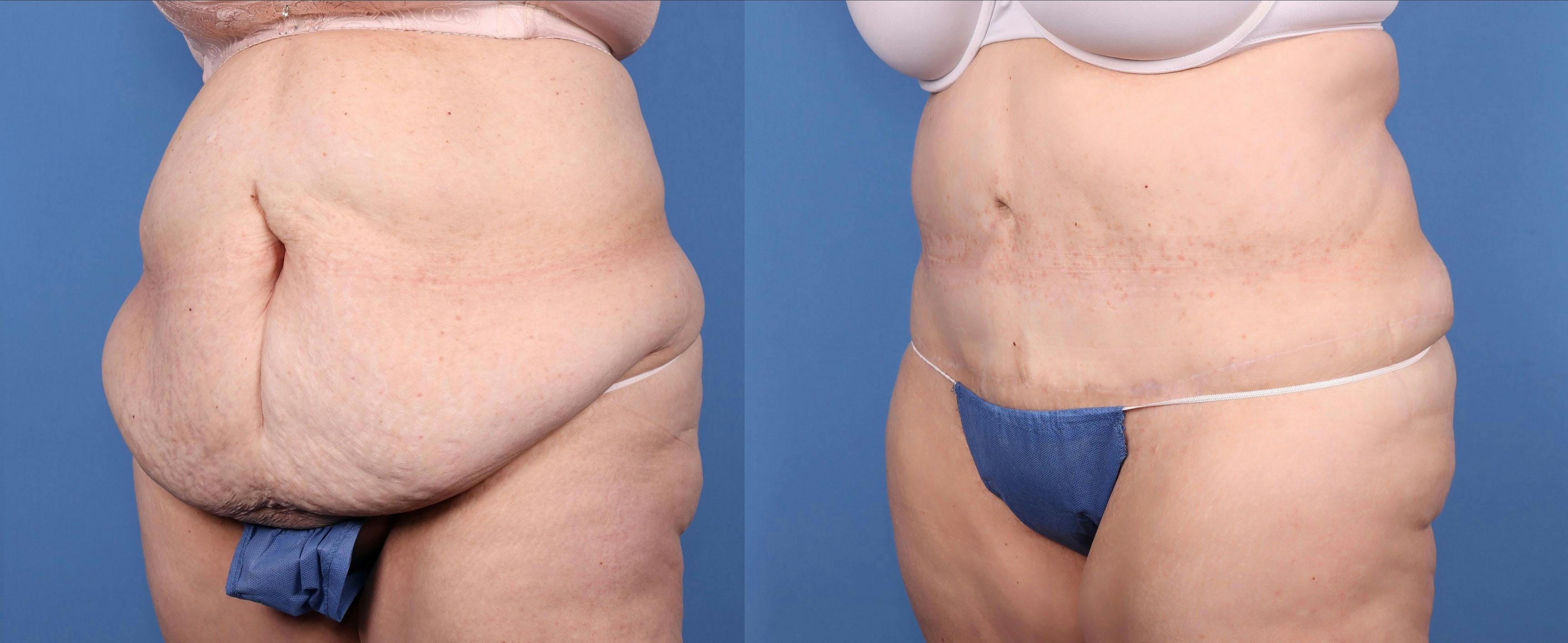 Tummy Tuck Before & After Gallery - Patient 146924658 - Image 2