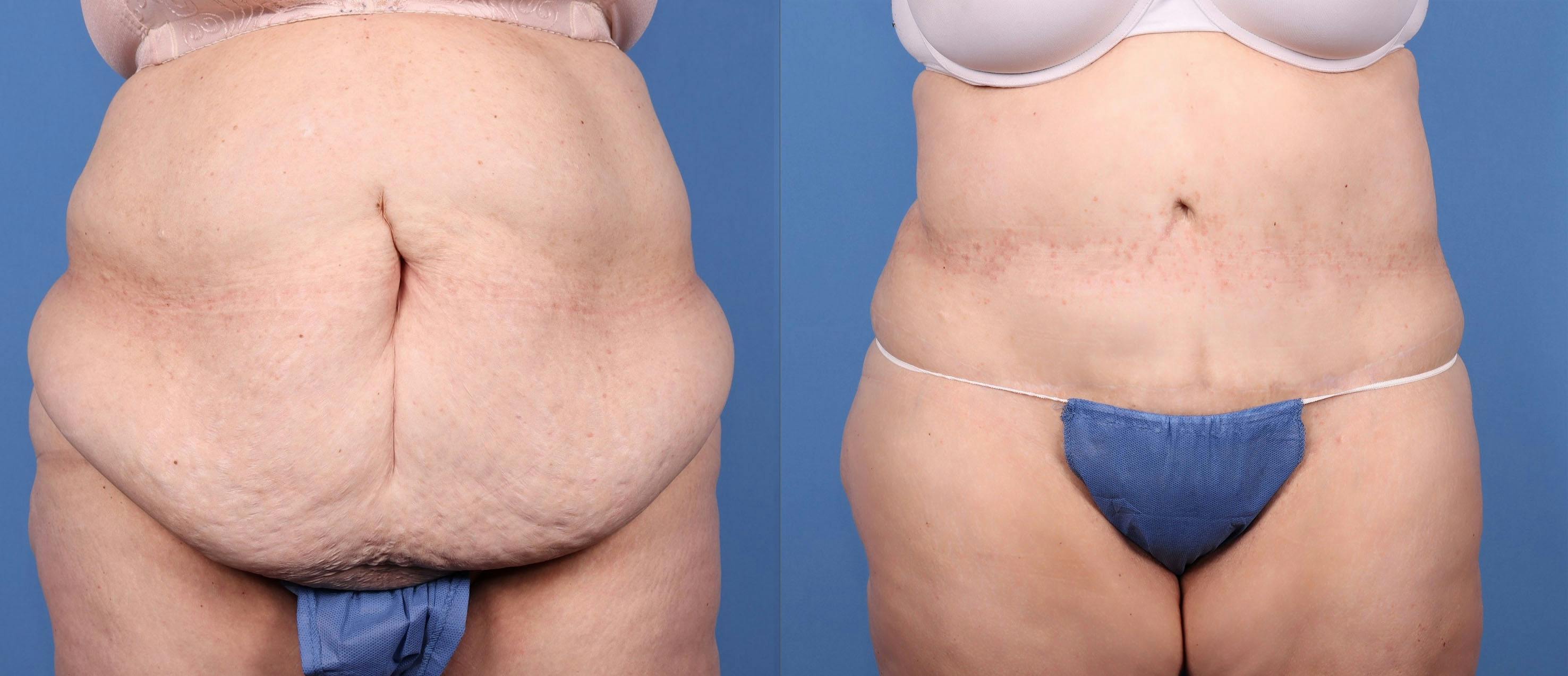 Tummy Tuck Before & After Gallery - Patient 146924658 - Image 1