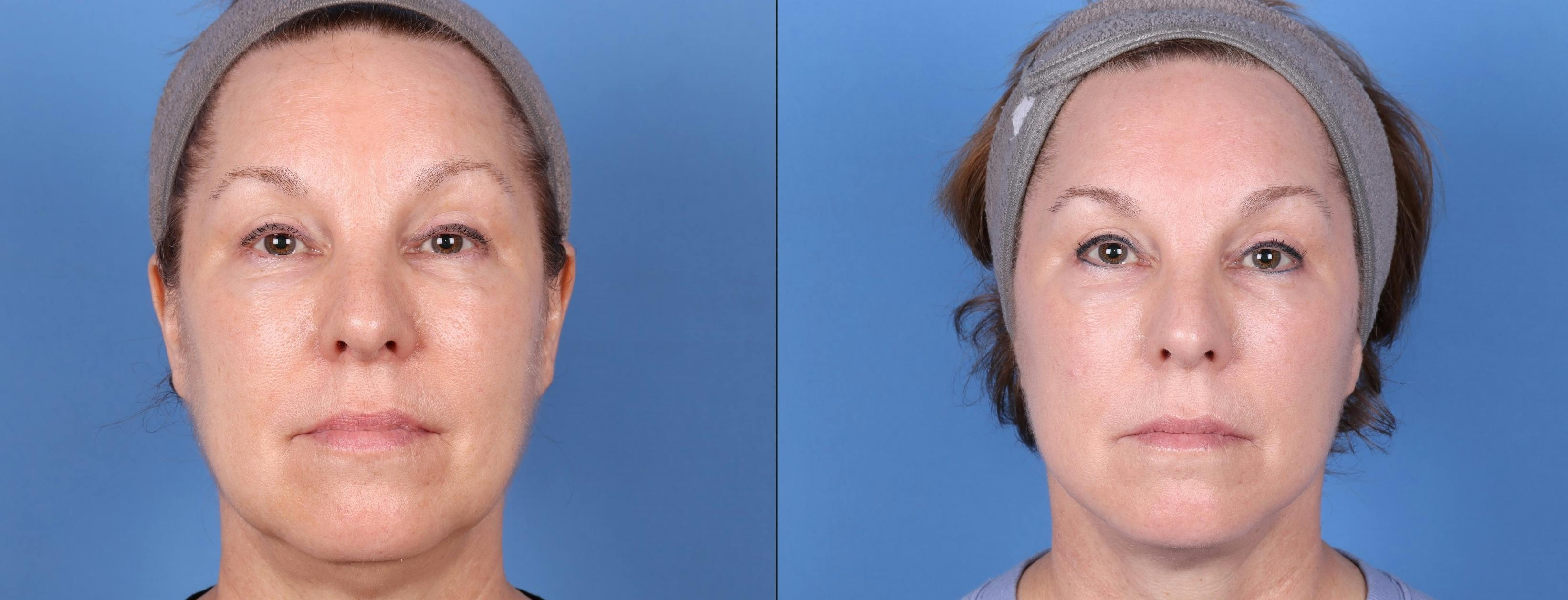 Face Lift Before & After Gallery - Patient 147034641 - Image 1