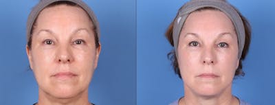 Face Lift Before & After Gallery - Patient 147034641 - Image 1
