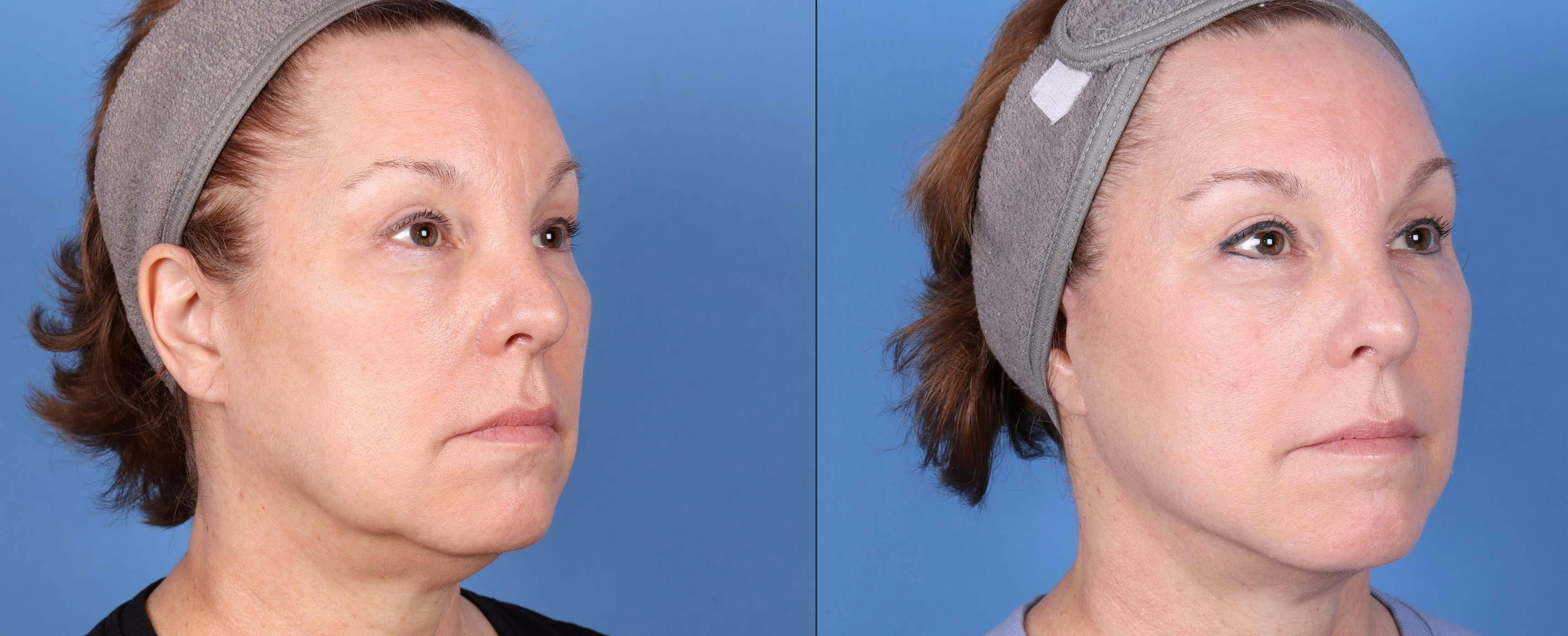 Face Before & After Gallery - Patient 149385107 - Image 2