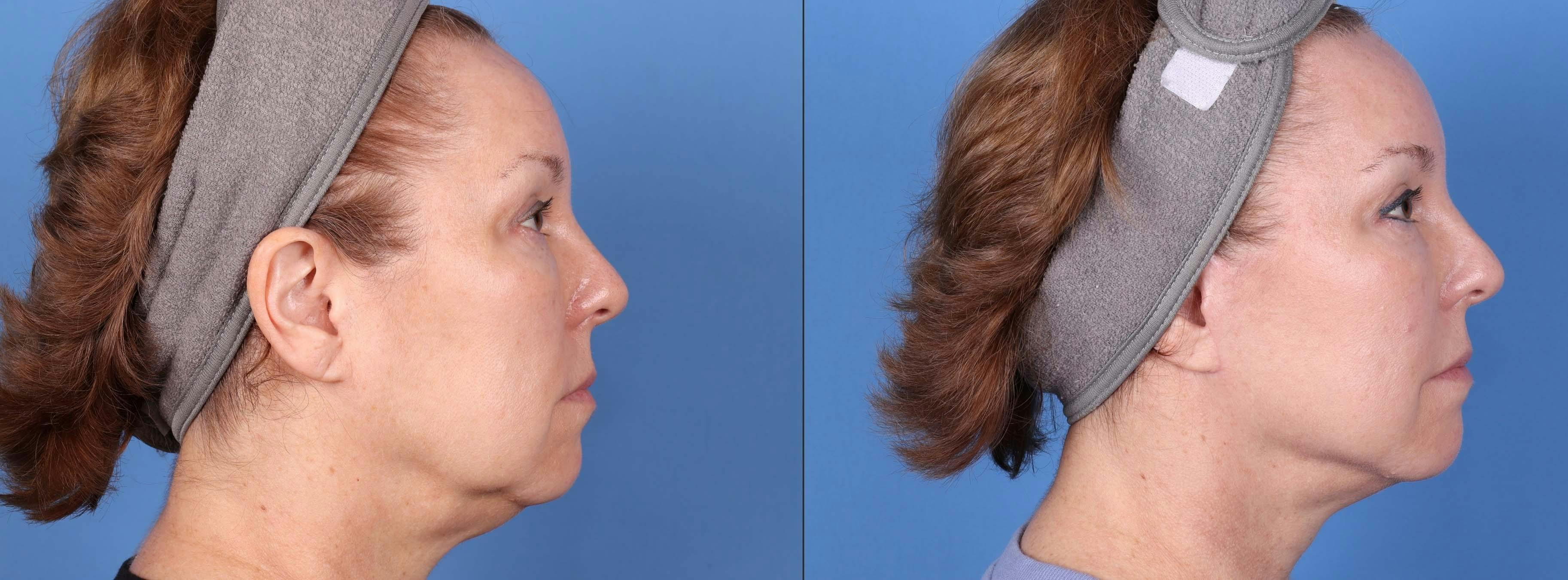 Face Lift Before & After Gallery - Patient 147034641 - Image 3