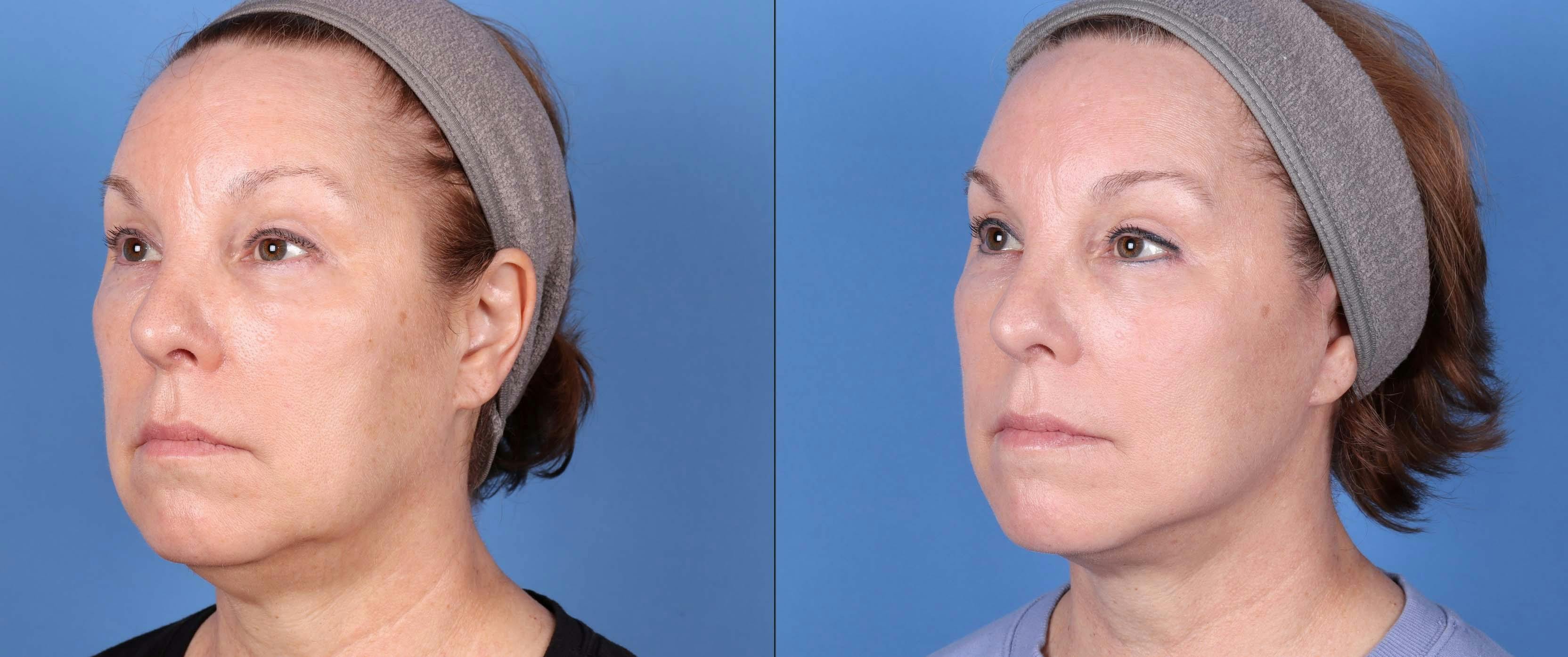 Face Before & After Gallery - Patient 149385107 - Image 4