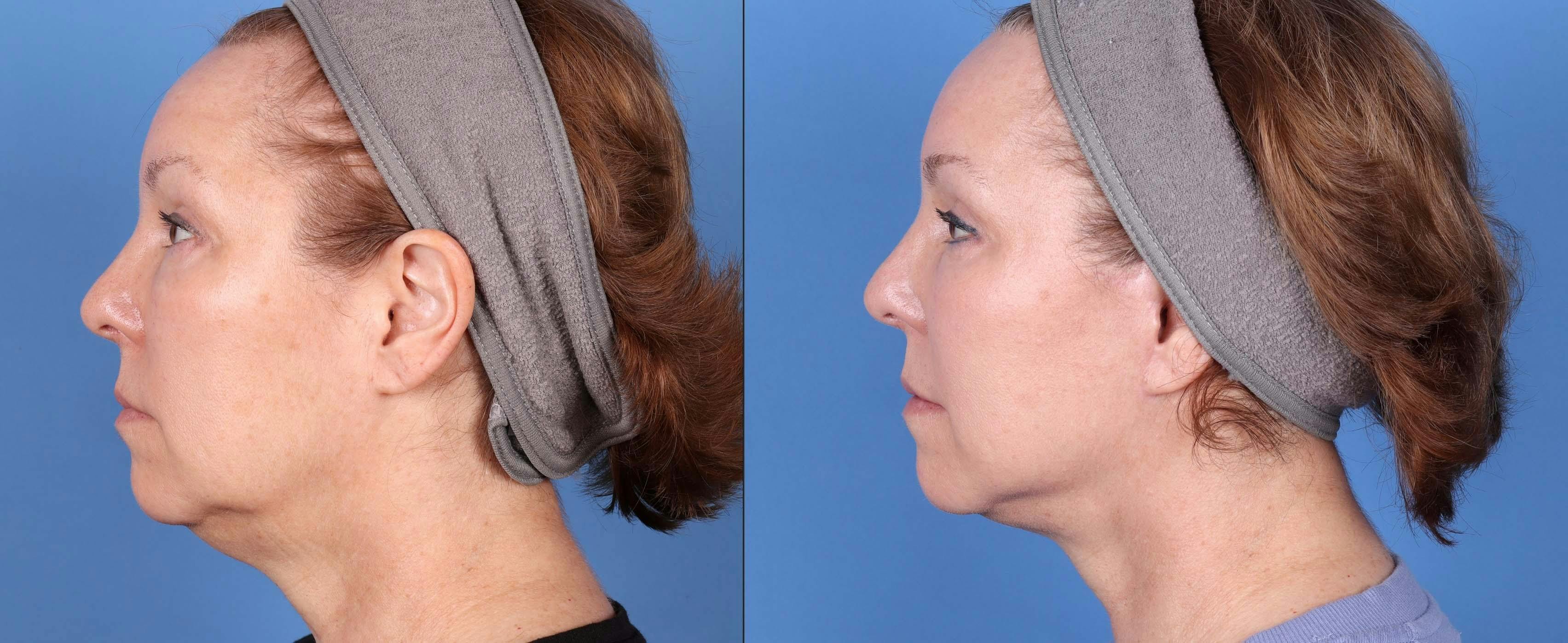 Liposuction Before & After Gallery - Patient 147034650 - Image 5
