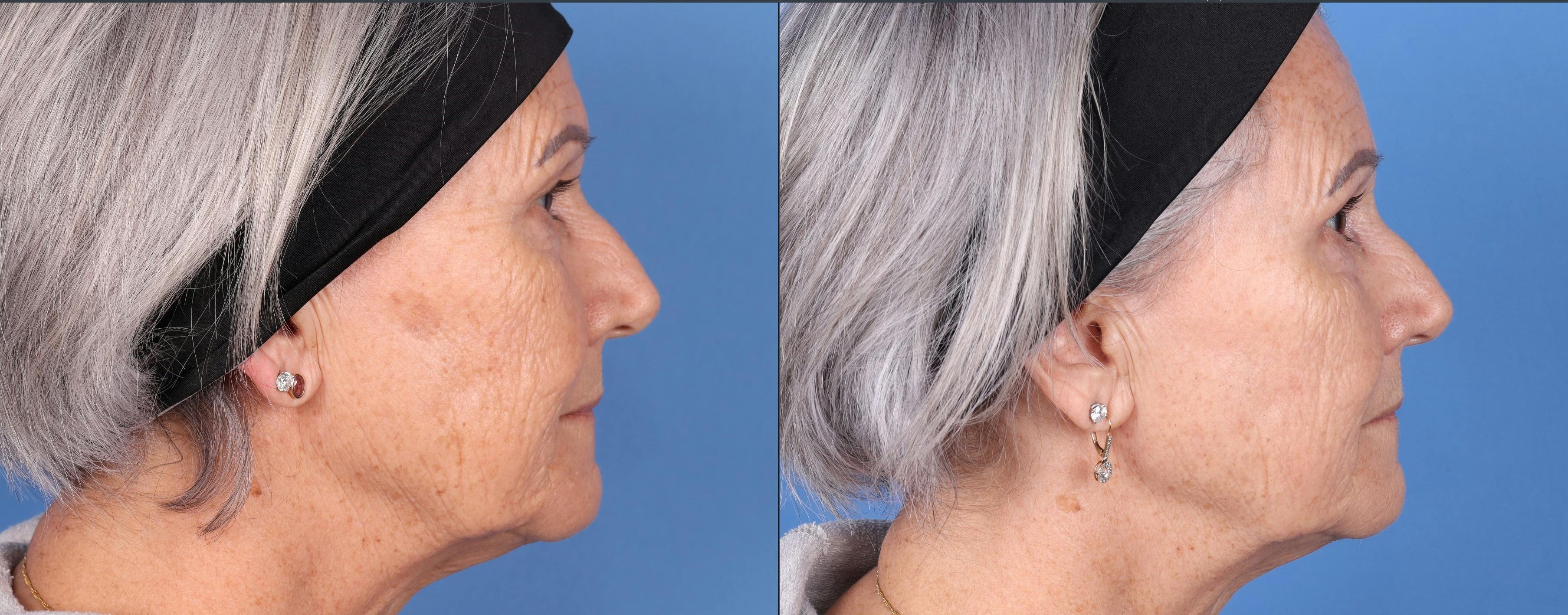 BBL Laser Before & After Gallery - Patient 147035135 - Image 2