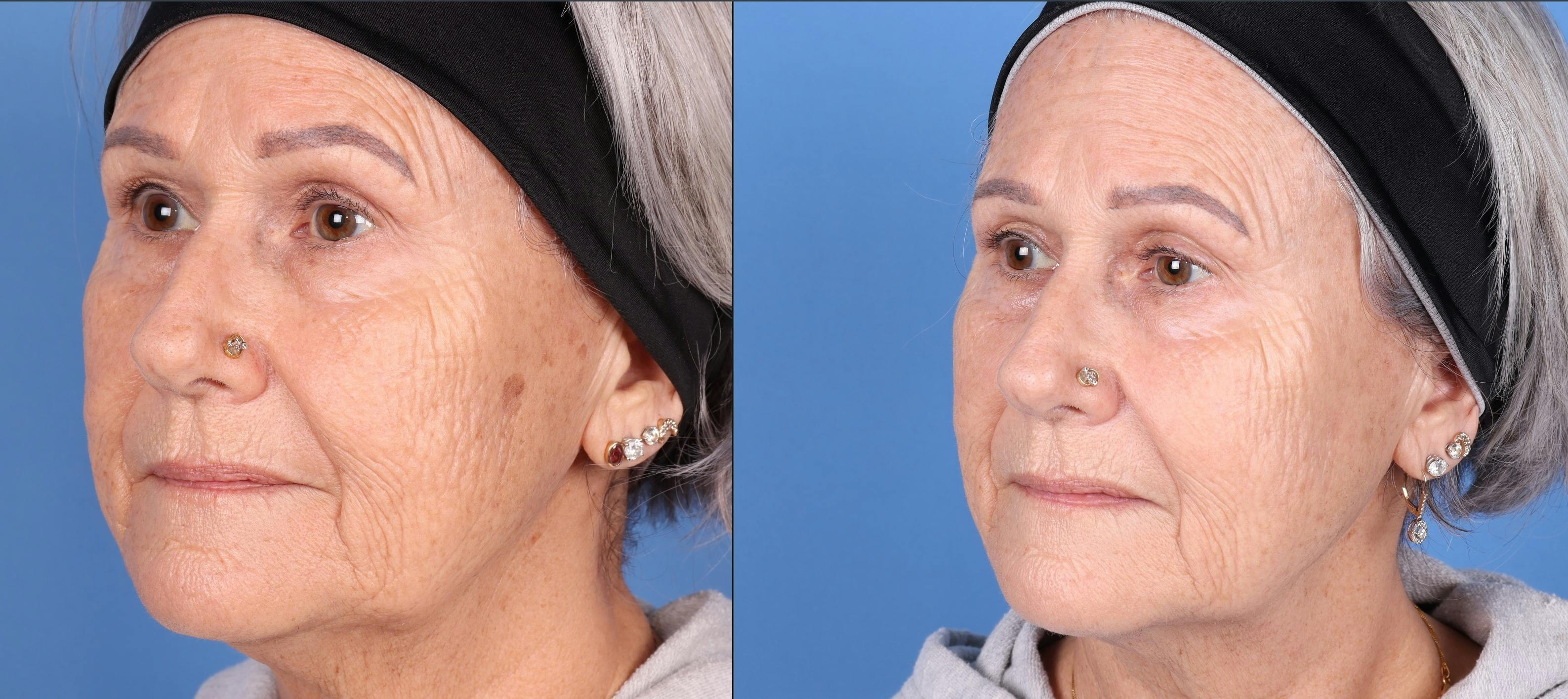 BBL Laser Before & After Gallery - Patient 147035135 - Image 3