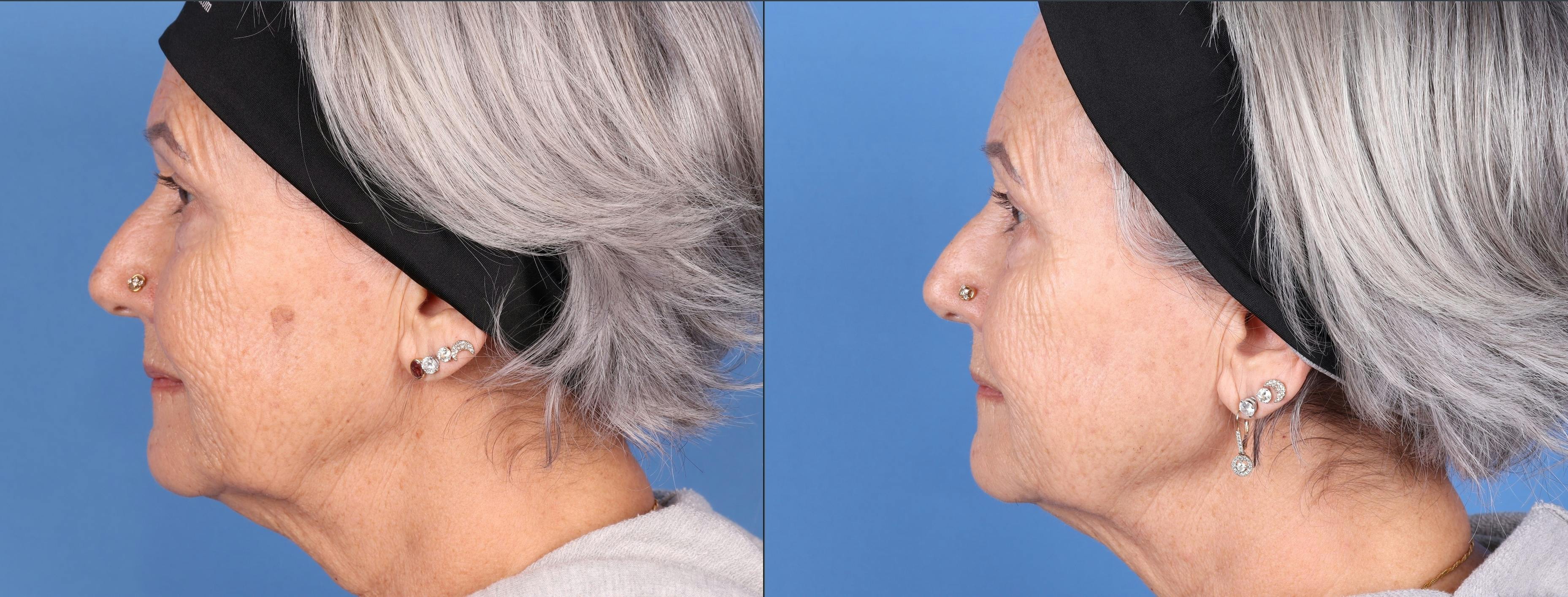 BBL Laser Before & After Gallery - Patient 147035135 - Image 4
