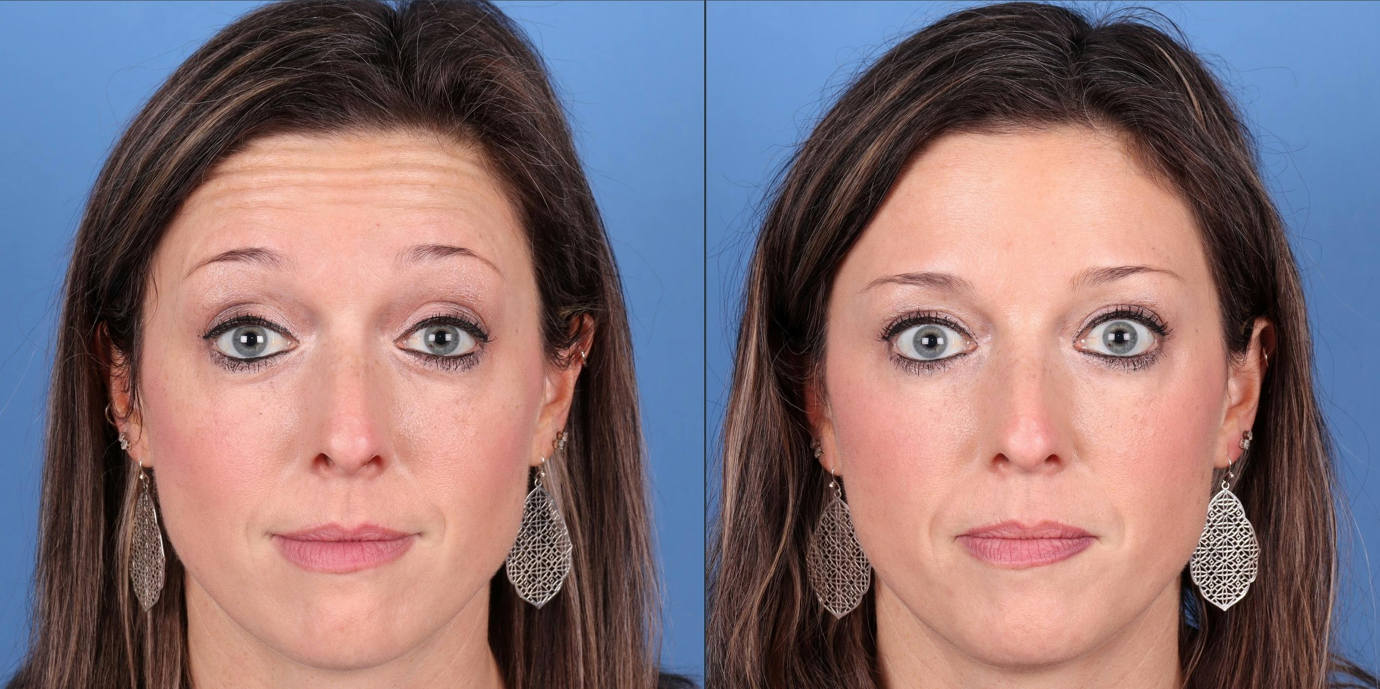 DAXXIFY Before & After Gallery - Patient 147035228 - Image 2