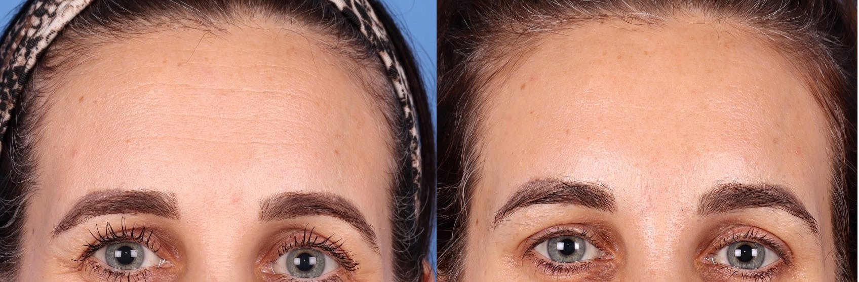 DAXXIFY Before & After Gallery - Patient 147035236 - Image 1