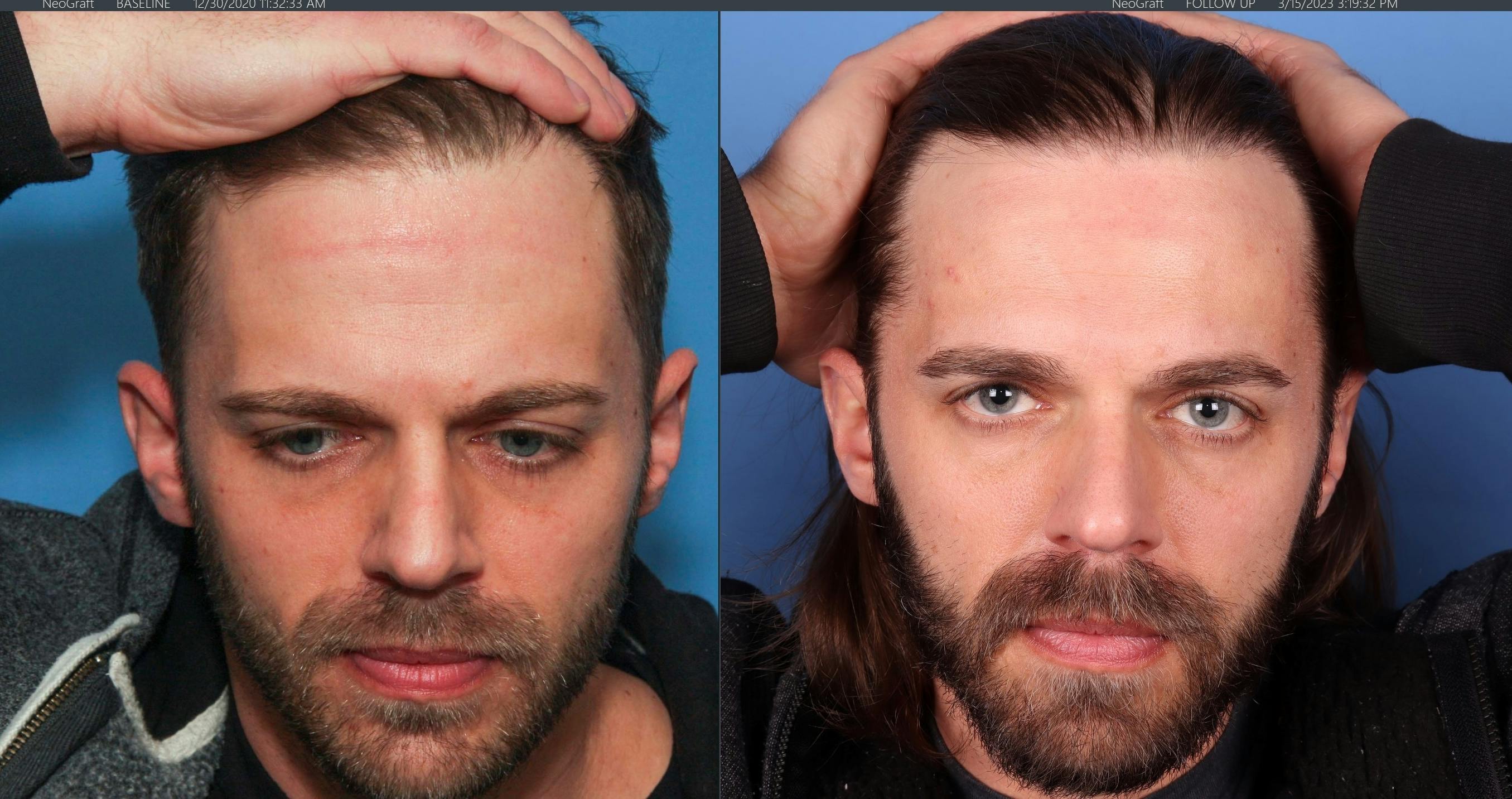 NeoGraft Hair Restoration Before & After Gallery - Patient 147103584 - Image 1