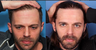 NeoGraft Hair Restoration Before & After Gallery - Patient 147103584 - Image 1