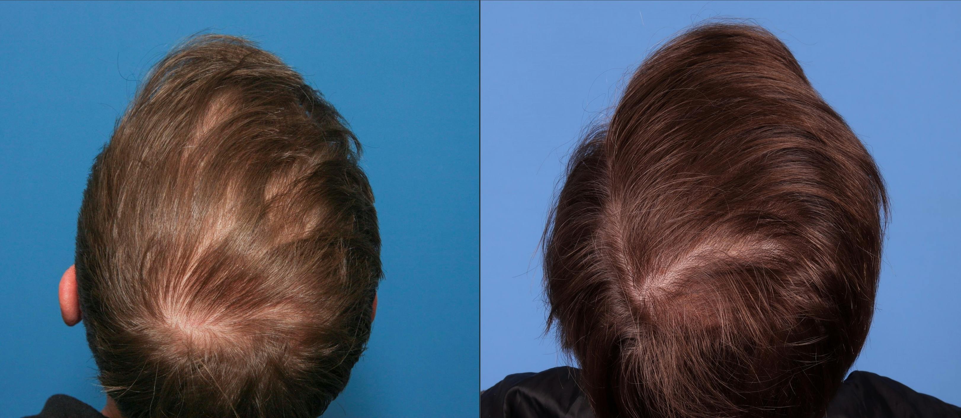 NeoGraft Hair Restoration Before & After Gallery - Patient 147103584 - Image 3