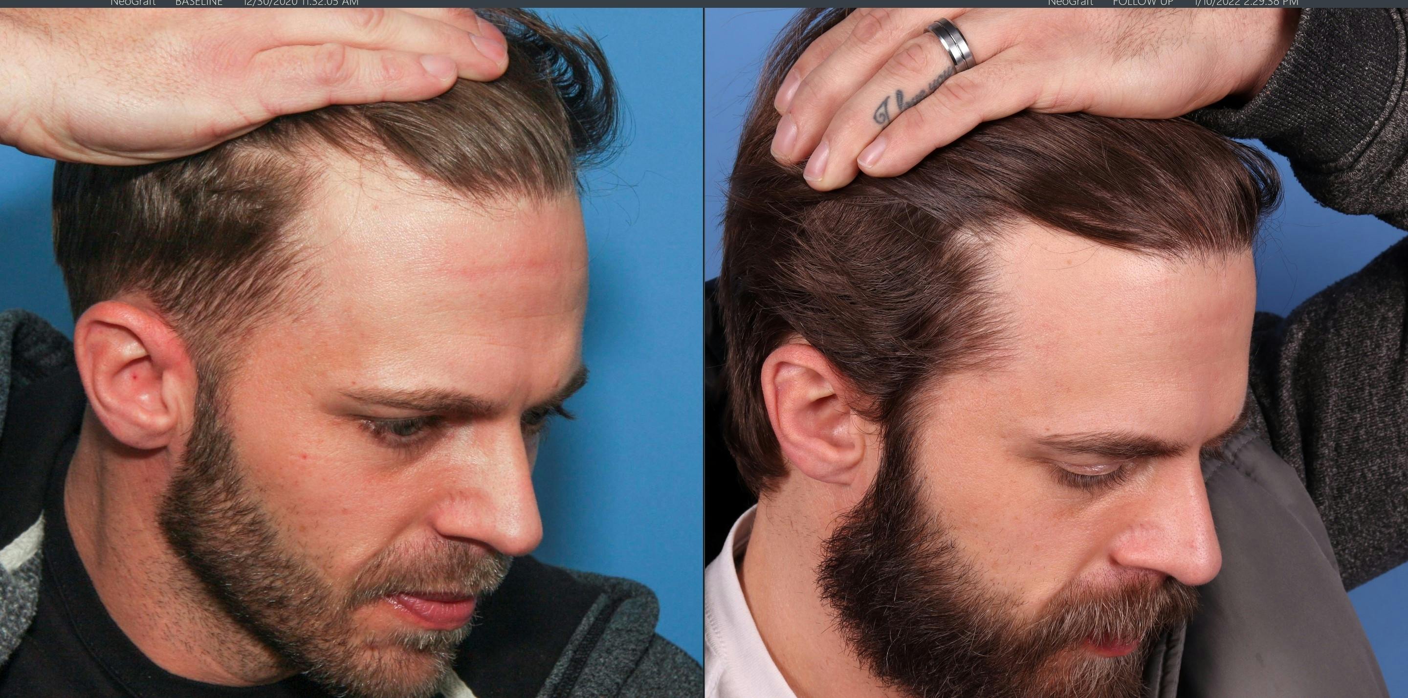 NeoGraft Hair Restoration Before & After Gallery - Patient 147103584 - Image 4