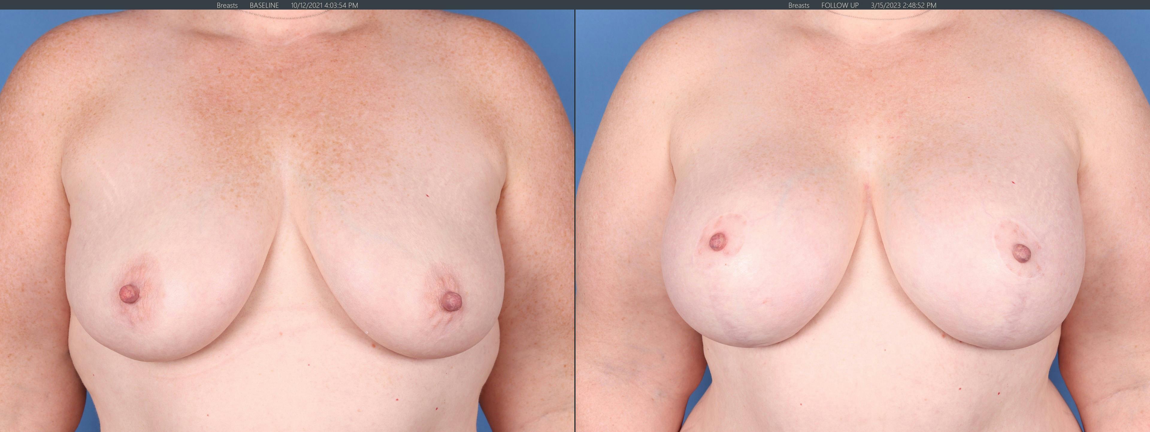 Breast Lift with Augmentation Before & After Gallery - Patient 147103900 - Image 1