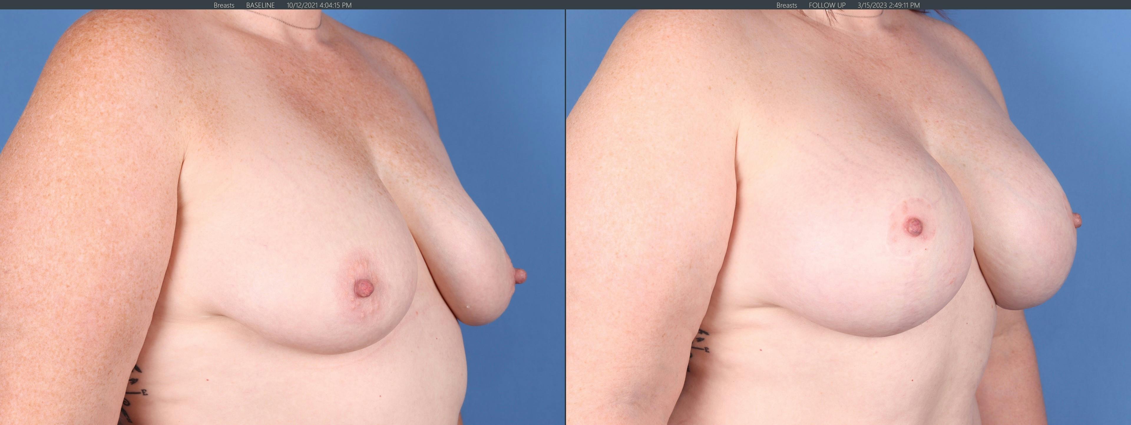 Breast Lift with Augmentation Before & After Gallery - Patient 147103900 - Image 2