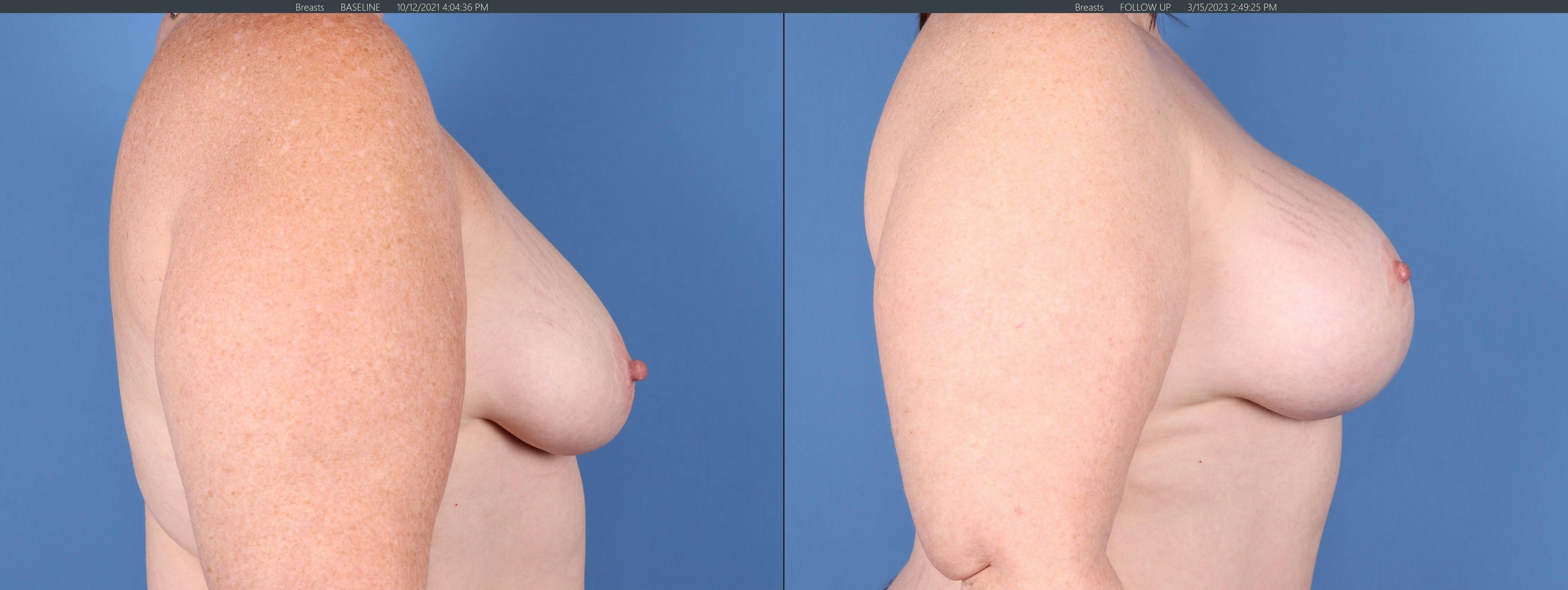 Breast Lift with Augmentation Before & After Gallery - Patient 147103900 - Image 3