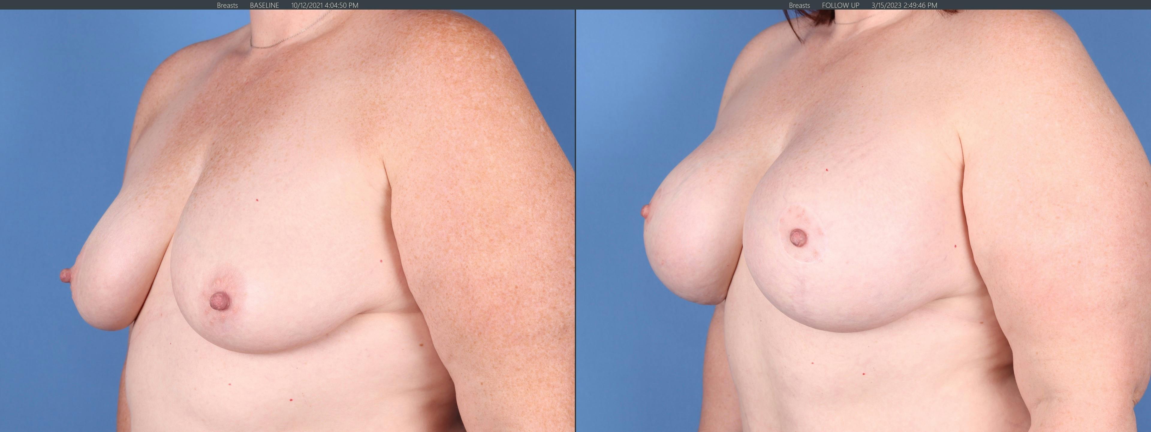 Breast Lift with Augmentation Before & After Gallery - Patient 147103900 - Image 4