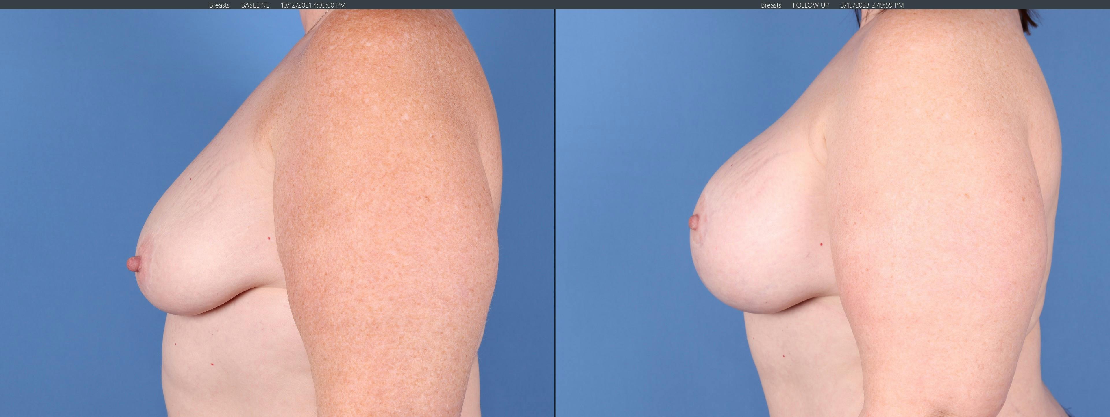 Breast Lift with Augmentation Before & After Gallery - Patient 147103900 - Image 5