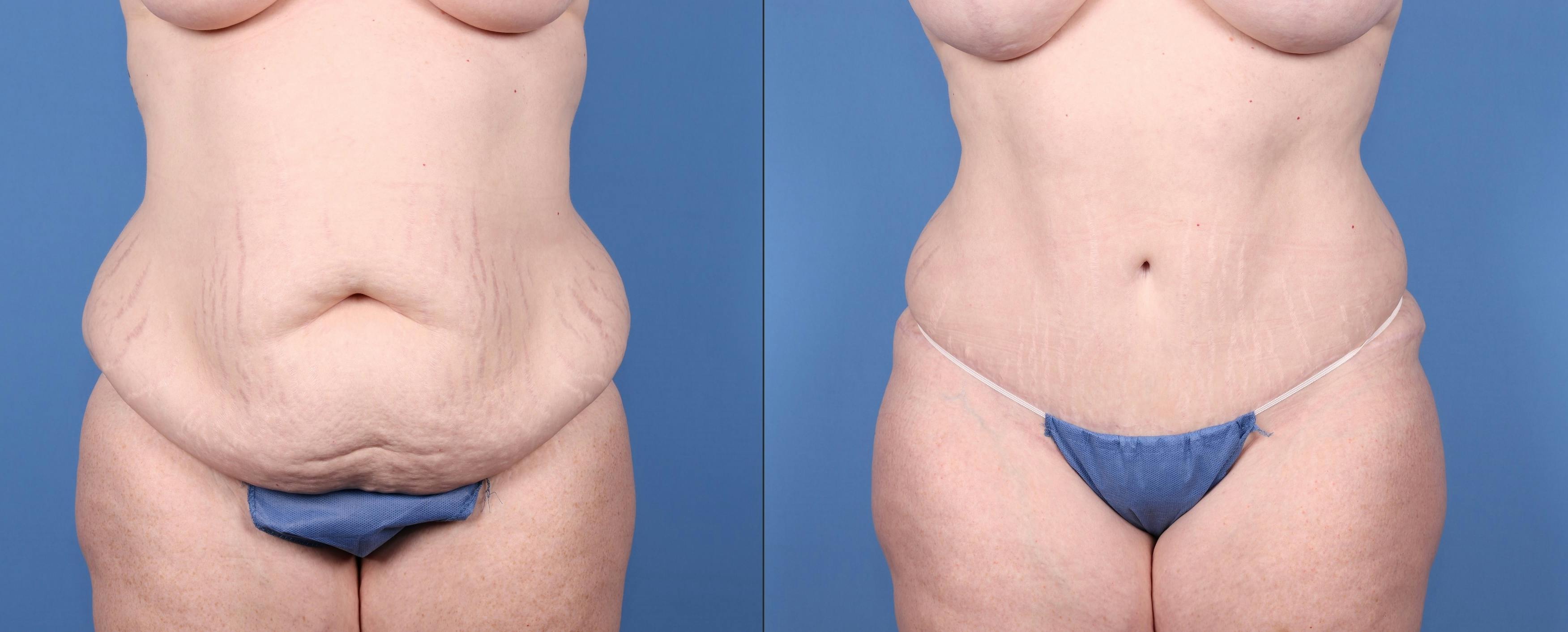 Breast Lift with Augmentation Before & After Gallery - Patient 147103900 - Image 6