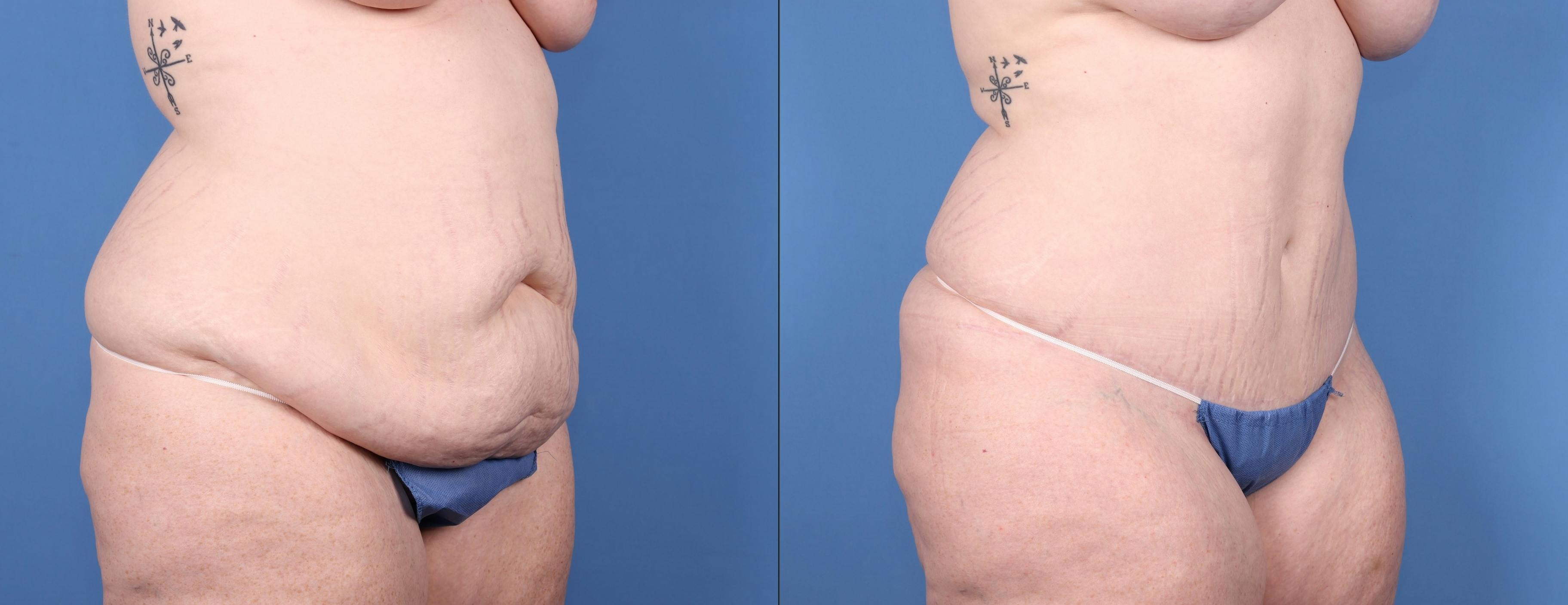 Tummy Tuck Before & After Gallery - Patient 147103896 - Image 2