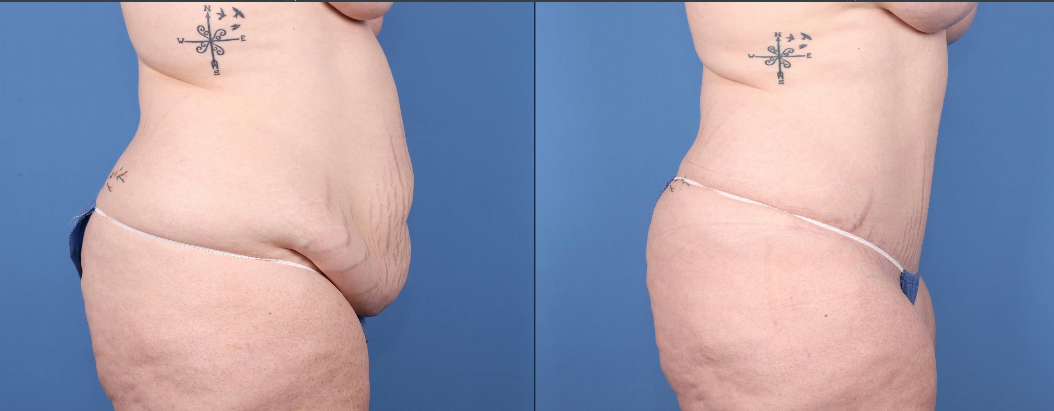 Tummy Tuck Before & After Gallery - Patient 147103896 - Image 3